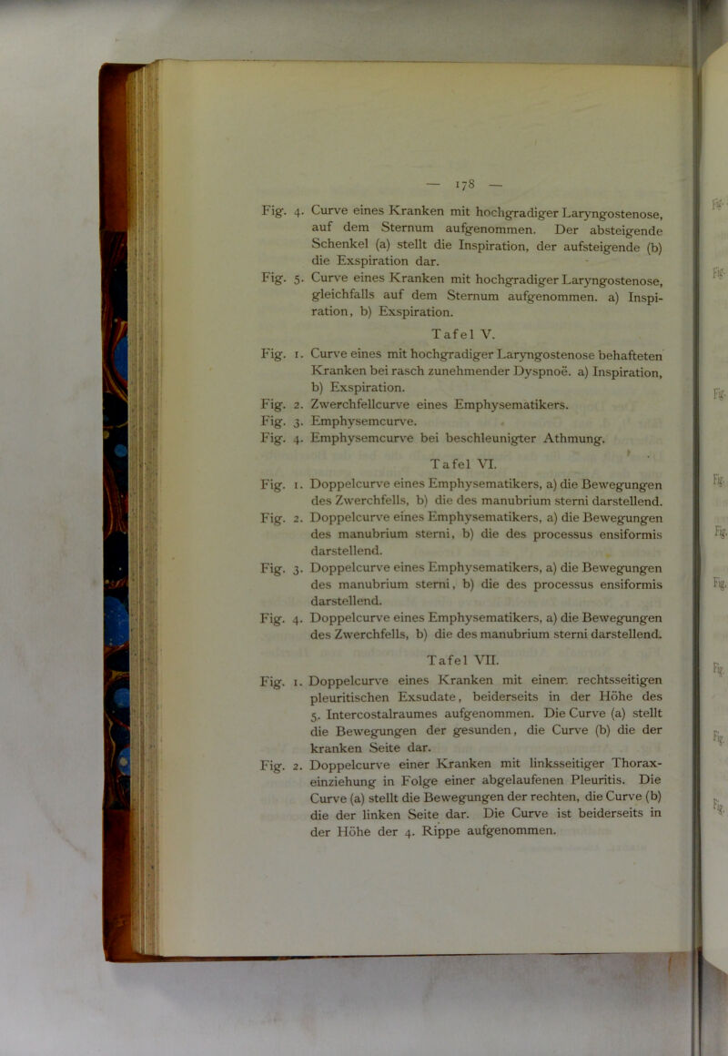 •/ •1» il' 7 -i ■!/{ . ii mt Fig, 4. Curve eines Kranken mit hochgradiger Laryngostenose, äuf dem Sternum aufgenommen. Der absteigende Schenkel (a) stellt die Inspiration, der aufsteigende (b) die Exspiration dar. Fig”- 5* Curve eines Kranken mit hochgradiger Laryngostenose, gleichfalls auf dem Sternum aufgenommen, a) Inspi- ration, b) Exspiration. Tafel V. Fig. I. Curve eines mit hochgradiger Laryngostenose behafteten Kranken bei rasch zunehmender Dyspnoe, a) Inspiration, b) Exspiration. Fig. 2. Zwerchfellcurve eines Emphysematikers. Fig. 3. Emphysemcurve. Fig. 4. Emphysemcurve bei beschleunigter Athmung. Tafel VI. Fig. I. Doppelcurve eines Emphysematikers, a) die Bewegungen des Zwerchfells, b) die des manubrium stemi darstellend. Fig. 2. Doppelcur\'e eines Emphysematikers, a) die Bewegungen des manubrium stemi, b) die des processus ensiformis darstellend. Fig. 3. Doppelcurve eines Emphysematikers, a) die Bewegungen des manubrium stemi, b) die des processus ensiformis darstellend. Fig. 4. Doppelcurv'e eines Emphysematikers, a) die Bewegungen des Zwerchfells, b) die des manubrium stemi darstellend. Tafel \TI. Fig. I. Doppelcurve eines Kranken mit einem rechtsseitigen pleuritischen Exsudate, beiderseits in der Höhe des 5,. Intercostalraumes aufgenommen. Die Curve (a) stellt die Bewegungen der gesunden, die Cur\'e (b) die der kranken Seite dar. Fig. 2. Doppelcurv^e einer Kranken mit linksseitiger Thorax- einziehung in Folge einer abgelaufenen Pleuritis. Die Curve (a) stellt die Bewegungen der rechten, die Curve (b) die der linken Seite dar. Die Curve ist beiderseits in der Höhe der 4. Rippe aufgenommen.