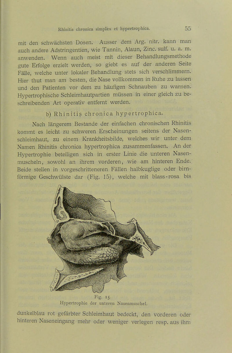 mit den schwächsten Dosen. Ausser dem Arg. nitr. kann man auch andere Adstringentien, wie Tannin, Alaun, Zinc. sulf. u. a. m. anwenden. Wenn auch meist mit dieser Behandlungsmethode gute Erfolge erzielt werden, so giebt es auf der anderen Seite Fälle, welche unter lokaler Behandlung stets sich verschlimmern. Hier thut man am besten, die Nase vollkommen in Ruhe zu lassen und den Patienten vor dem zu häufigen Schnauben zu warnen. Hypertrophische Schleimhautpartien müssen in einer gleich zu be- schreibenden Art operativ entfernt werden. b) Rhinitis chronica hypertrophica. Nach längerem Bestände der einfachen chronischen Rhinitis kommt es leicht zu schweren Erscheinungen seitens der Nasen- schleimhaut, zu einem Krankheitsbilde, welches wir unter dem Namen Rhinitis chronica hypertrophica zusammenfassen. An der Hypertrophie beteiligen sich in erster Linie die unteren Nasen- muscheln, sowohl an ihrem vorderen, wie am hinteren Ende. Beide stellen in vorgeschritteneren Fällen halbkuglige oder bim- förmige Geschwülste dar (Fig. 15), welche mit blass-rosa bis F'g- iS- Hypertrophie der unteren Nasenmuschel. dunkelblau rot gefärbter Schleimhaut bedeckt, den vorderen oder hinteren Naseneingang mehr oder weniger verlegen resp. aus ihm