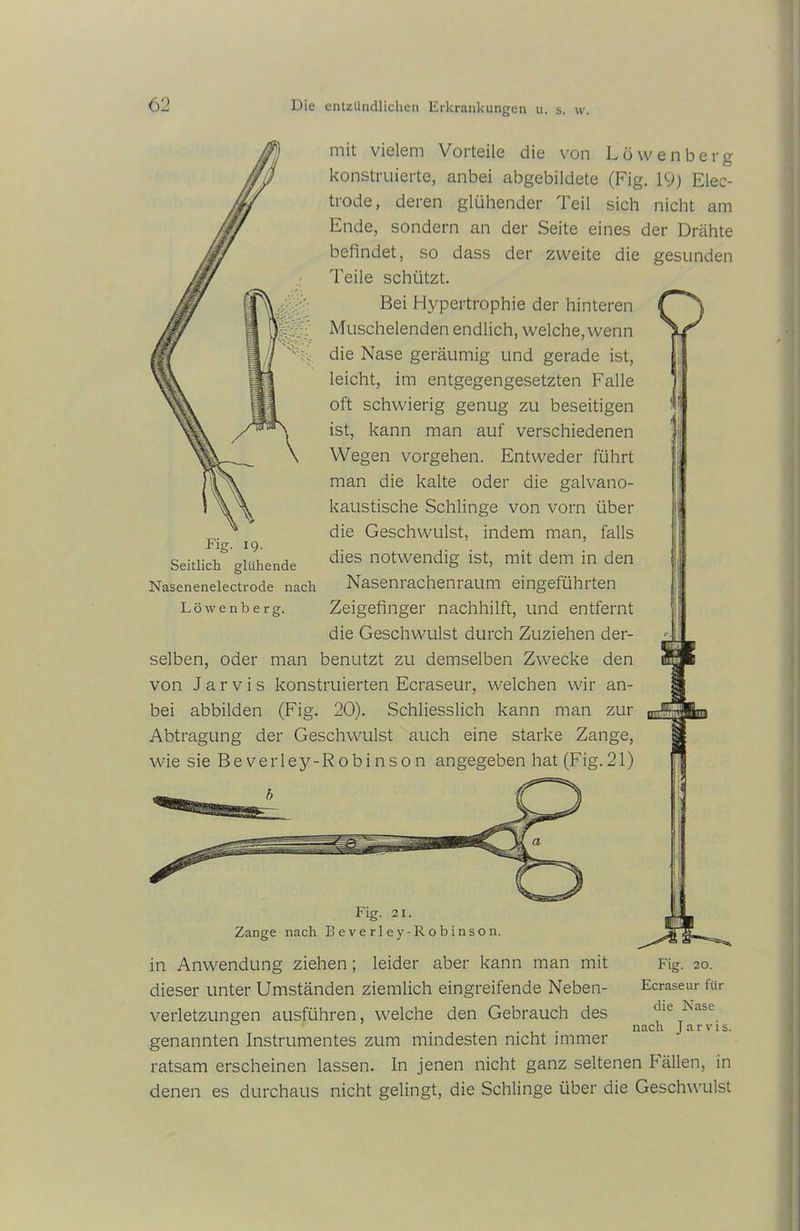 mit vielem Vorteile die von Löwenberg konstruierte, anbei abgebildete (Fig. 19) Elec- trode, deren glühender Teil sich nicht am Ende, sondern an der Seite eines der Drähte befindet, so dass der zweite die gesunden Teile schützt. Bei Hypertrophie der hinteren Muschelenden endlich, welche, wenn die Nase geräumig und gerade ist, leicht, im entgegengesetzten Falle oft schwierig genug zu beseitigen ist, kann man auf verschiedenen Wegen Vorgehen. Entweder führt man die kalte oder die galvano- kaustische Schlinge von vorn über die Geschwulst, indem man, falls dies notwendig ist, mit dem in den Nasenrachenraum eingeführten Zeigefinger nachhilft, und entfernt die Geschwulst durch Zuziehen der- selben, oder man benutzt zu demselben Zwecke den von J a r v i s konstruierten Ecraseur, welchen wir an- bei abbilden (Fig. 20). Schliesslich kann man zur Abtragung der Geschwulst auch eine starke Zange, wie sie Beverley-Robinson angegeben hat (Fig.21) 19. Seitlich glühende Nasenenelectrode nach Löw enberg. Fig. 21. Zange nach Beverley-Robinson. ipL in Anwendung ziehen; leider aber kann man mit dieser unter Umständen ziemlich eingreifende Neben- verletzungen ausführen, welche den Gebrauch des genannten Instrumentes zum mindesten nicht immer ratsam erscheinen lassen. In jenen nicht ganz seltenen Fällen, in denen es durchaus nicht gelingt, die Schlinge über die Geschwulst Fig. 20. Ecraseur für die Nase nach J a r v i s.