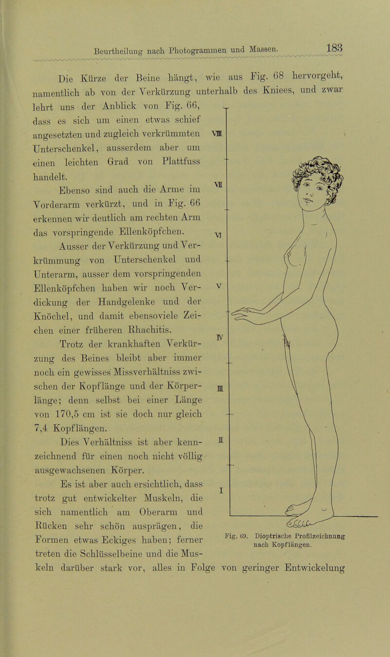 Die Kürze der Beine hängt, wie aus Fig. ü8 hervorgeht, namentlich ab von der Verkürzung unterhalb des Kniees, und zwar lehrt uns der Anblick von Fig. 66, dass es sich um einen etwas schief angesetzten und zugleich verkrümmten vm Unterschenkel, ausserdem aber um einen leichten Grrad von Plattfuss handelt. Ebenso sind auch die Arme im Vorderarm verkürzt, und in Fig. 66 erkennen wir deutlich am rechten Arm das vorspringende Ellenköpfchen. Ausser der Verkürzung und Ver- krümmung von Unterschenkel und Unterarm, ausser dem vorspringenden Ellenköpfchen haben wir noch Ver- dickung der Handgelenke und der Knöchel, und damit ebenso viele Zei- chen einer früheren Rhachitis. Trotz der krankhaften Verkür- zung des Beines bleibt aber immer noch ein gewisses Missverhältniss zwi- schen der Kopflänge und der Körper- länge; denn seihst hei einer Länge von 170,5 cm ist sie doch nur gleich 7,4 Kopflängen. Dies Verhältniss ist aber kenn- zeichnend für einen noch nicht völlig ausgewachsenen Körper. Es ist aber auch ersichtlich, dass trotz gut entwickelter Muskeln, die sich namentlich ain Oberarm und Rücken sehr schön ausprägen, die Formen etwas Eckiges Iraben; ferner treten die Schlüsselbeine und die Mus- keln darüber stark vor, alles in Folge von geringer Entwickelung