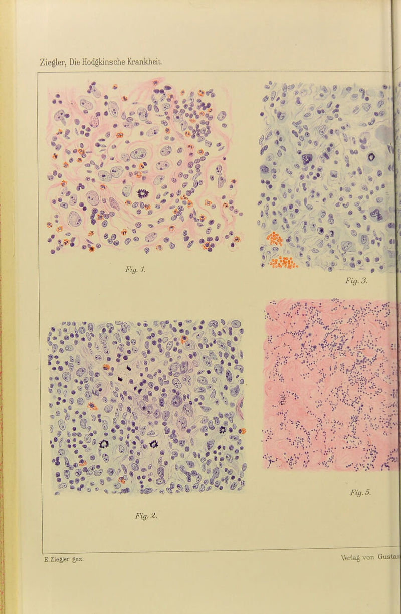 Ziegler, Die Hodgkinsche Krankheit. • « t •9 'i^<^'^ 0 j! 1 ^(9 « iß ■ff' X •••• ®» * • Fig. 3. -* V'' V. ,.'  • • • *: •■• • • • - », .\ : 1 .' •.' • • • ,*St* •  a  » • •• ••• > '  .... .'J-' . ' \ • ' • • >>•• ' ' fi' ,. Fig. 5. Verlaig vor. Gusta