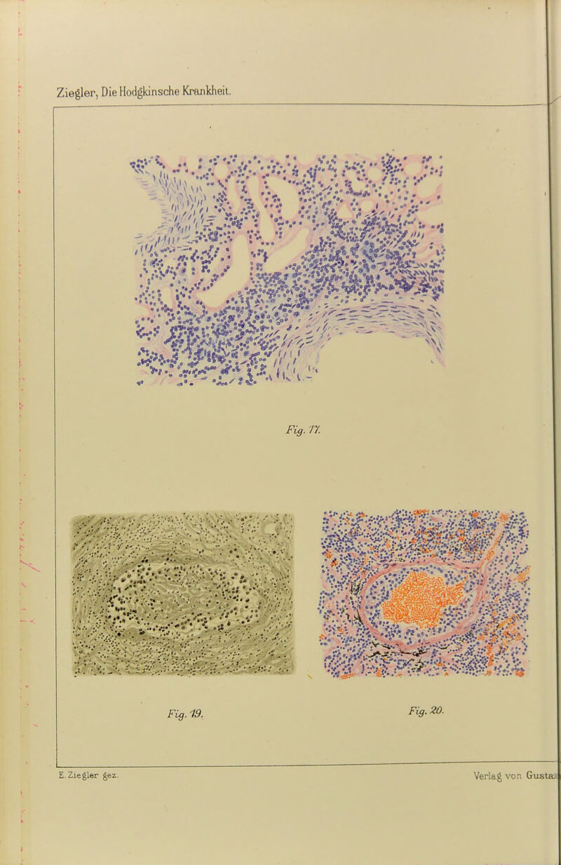 Ziegler, Die Hodgkinsche Krankheil. Fig.n Fig. 19. Fig. 20.