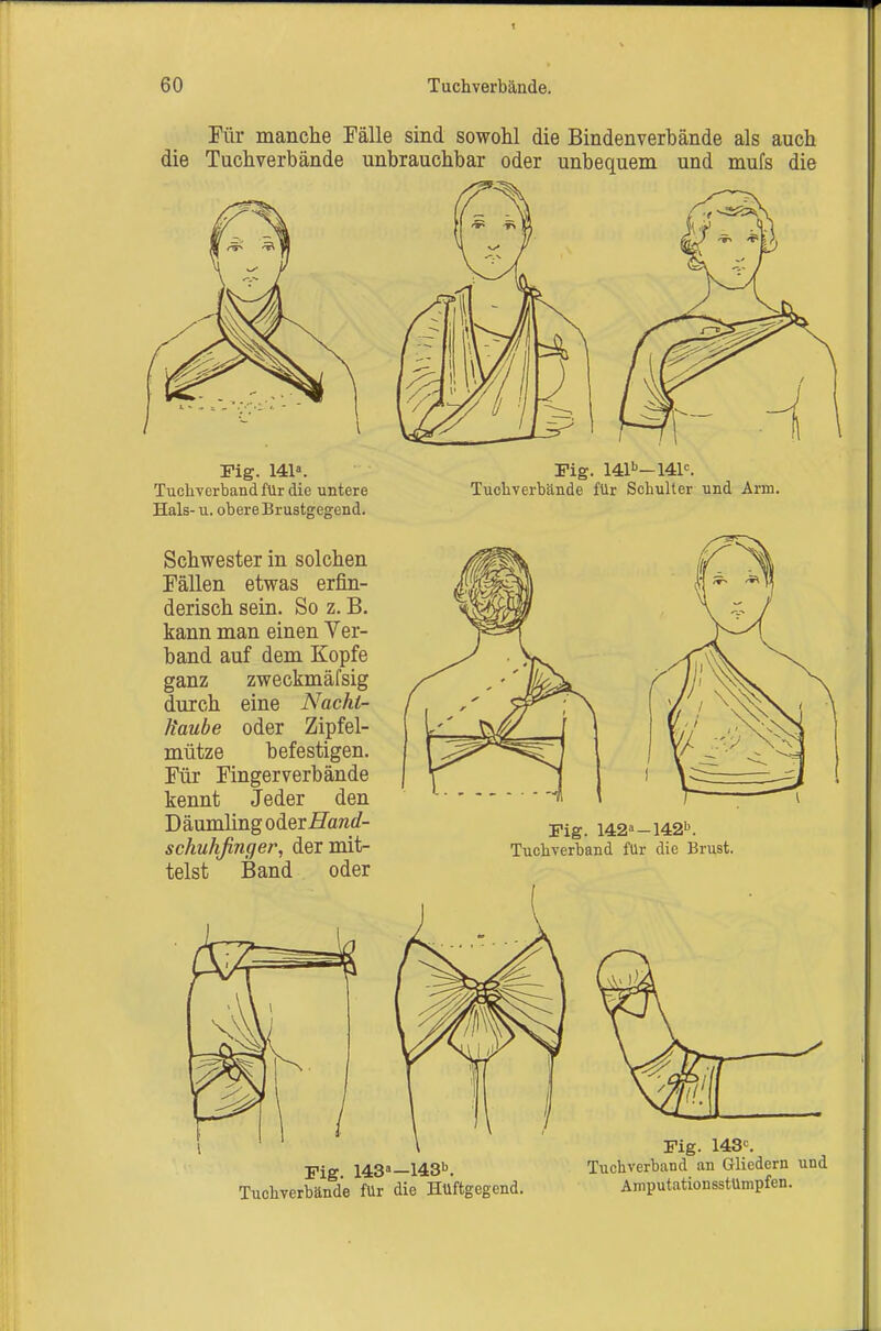 Für manche Fälle sind sowohl die Bindenverbände als auch die Tuchverbände unbrauchbar oder unbequem und mufs die Fig. 141«. Tuchverband für die untere Hals- u. obere Brustgegend. Schwester in solchen Fällen etwas erfin- derisch sein. So z. B. kann man einen Ver- band auf dem Kopfe ganz zweckmäfsig durch eine Nacht- Haube oder Zipfel- mütze befestigen. Für Fingerverbände kennt Jeder den Däumling odeiHand- schuhfiyiger, der mit- telst Band oder Fig. 141''—141^ Tuchverbände für Schulter und Arm. Fig. 142»-142''. Tuchverband für die Brust. Fig. 143«—143b. Tuchverbände für die Huftgegend. Fig. 143=. Tuchverband an Gliedern und Amputationsstümpfen.