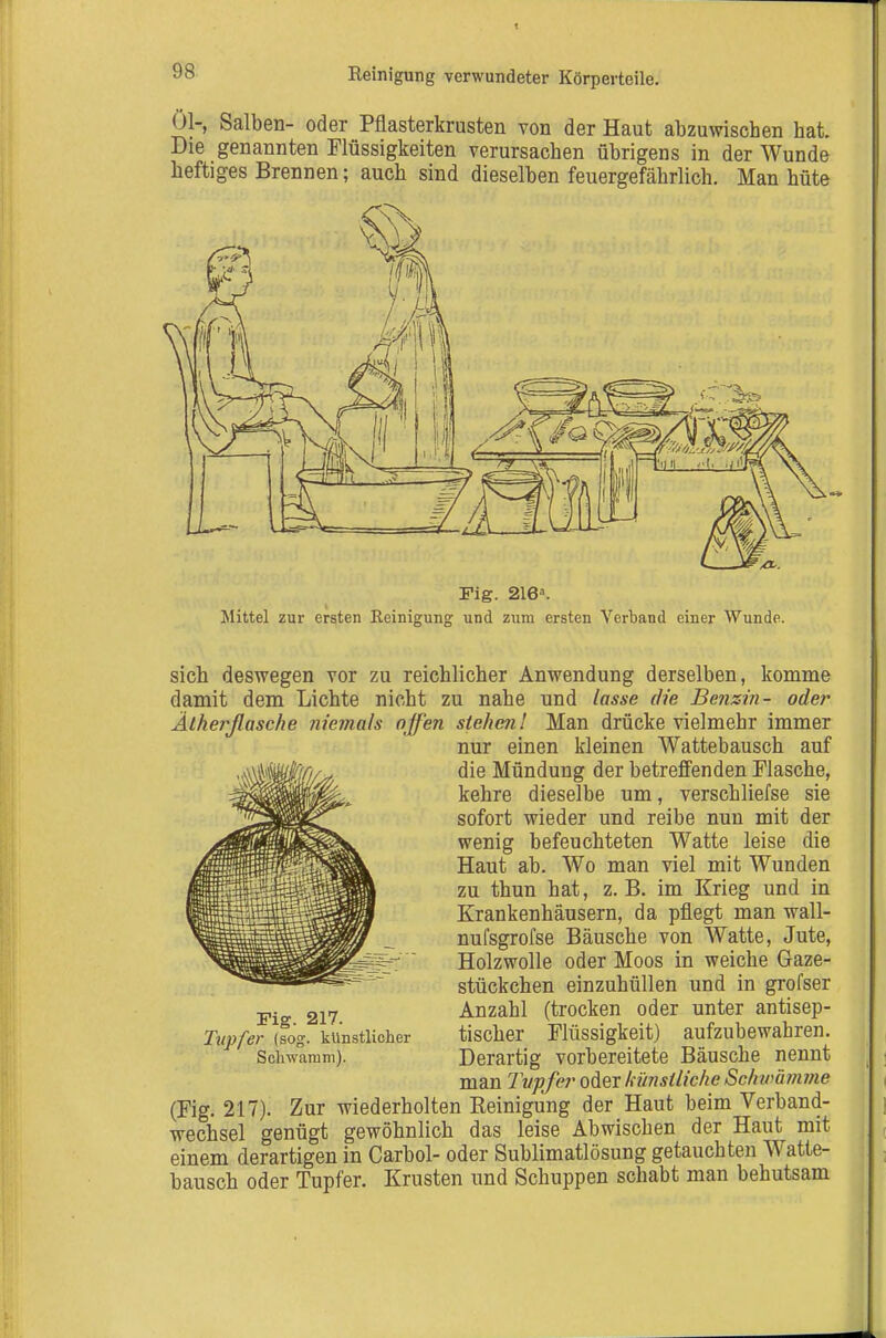 Ol-, Salben- oder Pflasterkrusten von der Haut abzuwischen hat. Die genannten Flüssigkeiten verursachen übrigens in der Wunde heftiges Brennen; auch sind dieselben feuergefährlich. Man hüte Fig. 216^ Mittel zur ersten Reinigung und zum ersten Verband einer Wunde. sich deswegen vor zu reichlicher Anwendung derselben, komme damit dem Lichte nicht zu nahe und lasse die Benzin- oder Ätherßasche ?iie?nals offen stehen! Man drücke vielmehr immer nur einen kleinen Wattebausch auf die Mündung der betreffenden Flasche, kehre dieselbe um, verschliefse sie sofort wieder und reibe nun mit der wenig befeuchteten Watte leise die Haut ab. Wo man viel mit Wunden zu thun hat, z. B. im Krieg und in Krankenhäusern, da pflegt man wall- nufsgrofse Bäusche von Watte, Jute, Holzwolle oder Moos in weiche Gaze- stückchen einzuhüllen und in grofser Anzahl (trocken oder unter antisep- tischer Flüssigkeit) aufzubewahren. Derartig vorbereitete Bäusche nennt man Tvpfe?^ oder künsiliche Schwämme (Fig. 217). Zur wiederholten Reinigung der Haut beim Verband- wechsel genügt gewöhnlich das leise Abwischen der Haut mit einem derartigen in Carbol- oder Sublimatlösung getauchten Watte- bausch oder Tupfer. Krusten und Schuppen schabt man behutsam Fig. 217. Tupfer (sog. künstlicher Scliwamm).