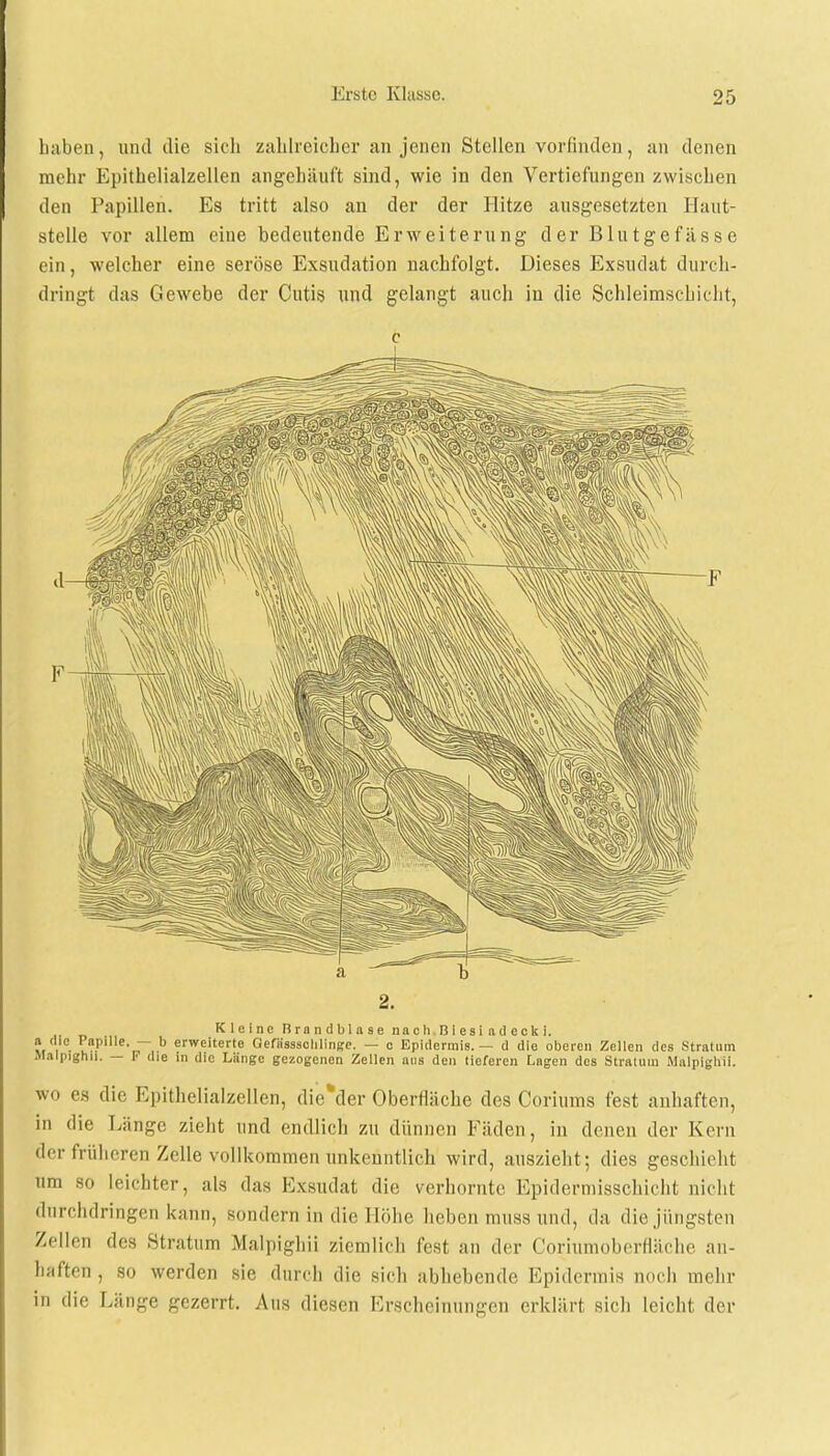 luiltcn, und die sich zahlreicher an jenen Stellen vorfinden, an denen mehr Epithelialzellen angehäuft sind, wie in den Vertiefungen zwischen den Papillen. Es tritt also an der der Hitze ausgesetzten Ilaut- stelle vor allem eine bedeutende Erweiterung der Blutgefässe ein, welcher eine seröse Exsudation nachfolgt. Dieses Exsudat durch- dringt das Gewebe der Cutis und gelangt auch in die Schleimschicht, c 2. Kleine Brandblase nach Biesi ad ecki. Mi- tü? o«* erweiterte Gefässscliliiifrc. — o Epidermis. — d die oberen Zellen des Stratum Malpighu. — F die in die Länge gezogenen Zellen aus den tieferen Lagen des Stratum Malpigliii. wo es die Epithelialzellen, die*der Oberfläche des Coriums fest anhaften, in die Länge zieht und endlich zu dünnen Fäden, in denen der Kern der früheren Zelle vollkommen unkenntlich wird, auszieht; dies geschieht um so leichter, als das Exsudat die verhornte Epidermisschicht nicht durchdringen kann, sondern in die Höhe liehen muss und, da die jüngsten Zellen des Stratum Malpighii ziemlich fest an der Coriumoberfläche an- haften , so werden sie durch die sich abhebende Epidermis noch mehr in die Länge gezerrt. Aus diesen Erscheinungen erklärt sich leicht der