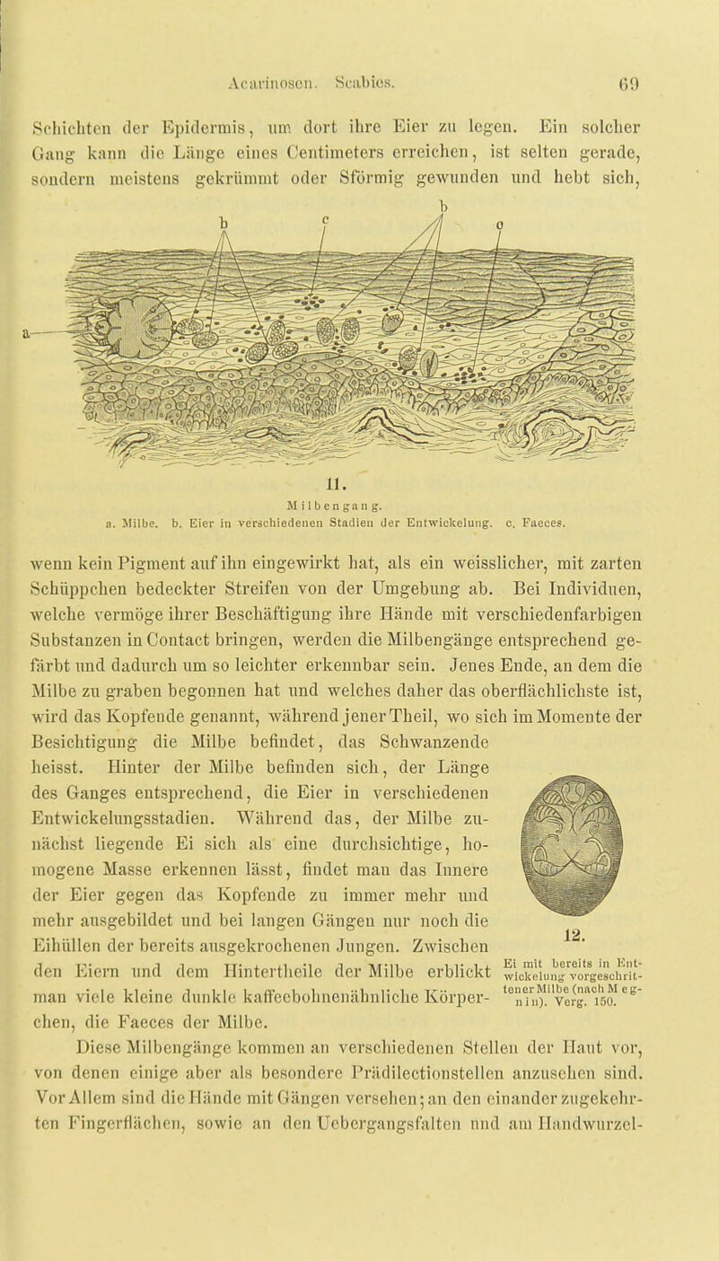 Schichten der Epidermis, um dort ihre Eier zu legen. Ein solcher Gang kann die Länge eines Centimeters erreichen, ist selten gerade, sondern meistens gekrümmt oder Sförmig gewunden und hebt sich, b b 11. M i 1 b e n g a n g. a. Milbe, b. Eier in verschiedenen Stadien der Entwicklung, c. Paeces. wenn kein Pigment auf ihn eingewirkt hat, als ein weisslicher, mit zarten Schüppchen bedeckter Streifen von der Umgebung ab. Bei Individuen, welche vermöge ihrer Beschäftigung ihre Hände mit verschiedenfarbigen Substanzen in Contact bringen, werden die Milbengänge entsprechend ge- färbt und dadurch um so leichter erkennbar sein. Jenes Ende, an dem die Milbe zu graben begonnen hat und welches daher das oberflächlichste ist, wird das Kopfende genannt, während jener Theil, wo sich im Momente der Besichtigung die Milbe befindet, das Schwanzende heisst. Hinter der Milbe befinden sich, der Länge des Ganges entsprechend, die Eier in verschiedenen Entwickelungsstadien. Während das, der Milbe zu- nächst liegende Ei sich als eine durchsichtige, ho- mogene Masse erkennen lässt, findet man das Innere der Eier gegen das Kopfende zu immer mehr und mehr ausgebildet und bei langen Gängen nur noch die Eihüllen der bereits ausgekrochenen Jungen. Zwischen den Eiern und dem Hintertheile der Milbe erblickt man viele kleine dunkle kaffeebohnenähnliche Körper- ßhen, die Faeces der Milbe. Diese Milbengänge kommen an verschiedenen Stellen der Haut vor, von denen einige aber als besondere Prädilectionstellen anzusehen sind. Vor Allem sind dieHände mit Gängen versehen; an.den-einander zugekehr- ten Fingerflächen, sowie an den Uebergangsfalten und am Handwurzel- Ei mit bereits In Ent- wickelung vorgeschrit- tener Milbe (nach M eg- niii). Verg. 150.