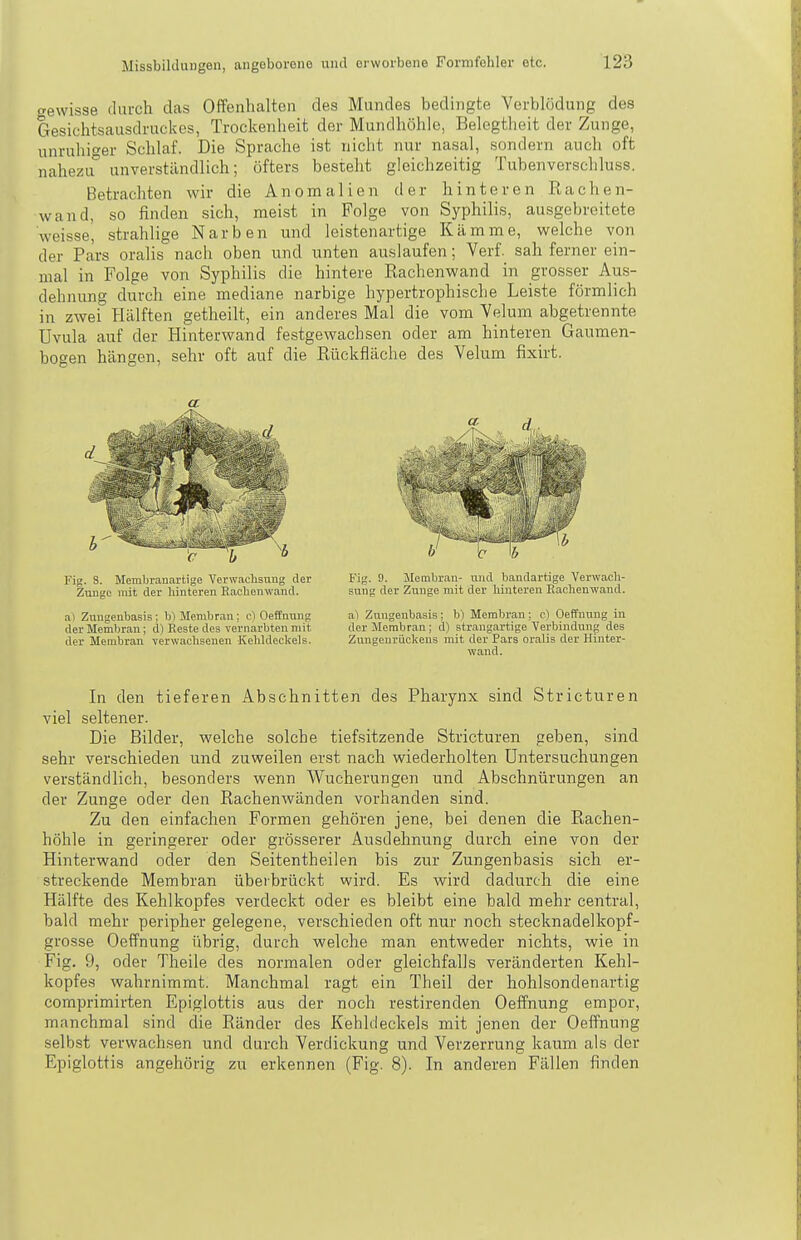 cewisse tUirch das Offenhalten des Mundes bedingte Verblödung des Gesichtsausdruckos, Trockenheit der Mundhöhle, Belegtheit der Zunge, unruhiger Schlaf. Die Sprache ist nicht nur nasal, sondern auch oft nahezu unverständlich; öfters besteht gleichzeitig Tubenverschluss. Betrachten wir die Anomalien der hinteren Rachen- wand, so finden sich, meist in Folge von Syphilis, ausgebreitete weisse, strahlige Narben und leistenartige Kämme, welche von der Pars oralis nach oben und unten auslaufen; Verf. sah ferner ein- mal in Folge von Syphilis die hintere Rachenwand in grosser Aus- dehnung durch eine mediane narbige hypertrophische Leiste förmlich in zwei Hälften getheilt, ein anderes Mal die vom Velum abgetrennte Uvula auf der Hinterwand festgewachsen oder am hinteren Gaumen- bogen hängen, sehr oft auf die Rückfläche des Velum fixirt. a Fig. 8. Membranartige Verwachsung der Zunge mit der hinteren Eachenwand. a) Ziingenbasis; h) Membran; c) Oeffnung der Membraii; d) Reste des vernarbten mit der Membran Terwachseuen Kelddeclcels. Fig. 9. Jlembran- vmd bandartige Verwach- sung der Zunge mit der hinteren Rachenwand. al Zungenbasis; b) Membran; c) Oeffnung in der Membran; d) strangartige Verbindung des Zungenriickeus mit der Pars oralis der Hinter- wand. In den tieferen Abschnitten des Pharynx sind Stricturen viel seltener. Die Bilder, welche solche tiefsitzende Stricturen geben, sind sehr verschieden und zuweilen erst nach wiederholten Untersuchungen verständlich, besonders wenn Wucherungen und Abschnürungen an der Zunge oder den Rachenwänden vorhanden sind. Zu den einfachen Formen gehören jene, bei denen die Rachen- höhle in geringerer oder grösserer Ausdehnung durch eine von der Hinterwand oder den Seitentheilen bis zur Zungenbasis sich er- streckende Membran überbrückt wird. Es wird dadurch die eine Hälfte des Kehlkopfes verdeckt oder es bleibt eine bald mehr central, bald mehr peripher gelegene, verschieden oft nur noch stecknadelkopf- grosse Oeffnung übrig, durch welche man entweder nichts, wie in Fig. 9, oder Theile des normalen oder gleichfalls veränderten Kehl- kopfes wahrnimmt. Manchmal ragt ein Theil der hohlsondenartig comprimirten Epiglottis aus der noch restirenden Oeffnung empor, manchmal sind die Ränder des Kehldeckels mit jenen der Oeffnung selbst verwachsen und durch Verdickung und Verzerrung kaum als der Epiglottis angehörig zu erkennen (Fig. 8). In anderen Fällen finden