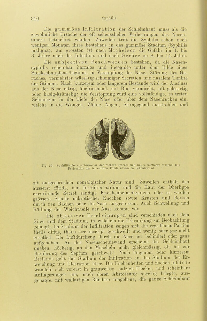 Die gummöse Infiltration der Schleimhaut muss als die gewöhnliche Ursache der oft scheusslichen Verheerungen des Nasen- innern hetrachtet werden. Zuweilen tritt die Syphilis schon nach wenigen Monaten ihres Bestehens in das gummöse Stadium (Syphilis maligna); am grössten ist nach Michelson die Gefahr im 1. bis 3. Jahre nach der Infection, und nach Gerber im 8. bis 14. Jahre. Die subjectiven Beschwerden bestehen, da die Nasen- syphilis scheinbar harmlos und incognito unter dem Bilde eines Stockschnupfens beginnt, in Verstopfung der Nase, Störung des Ge- ruches, vermehrter wässerig-schleimiger Secretion und nasalem Timbre der Stimme. Nach kürzerem oder längerem Bestände wird der Ausfluss aus der Nase eitrig, übelriechend, mit Blut vermischt, oft geleeartig oder käsig-krümelig; die Verstopfung wird eine vollständige, es treten Schmerzen in der Tiefe der Nase oder über dem Nasenrücken ein, welche in die Wangen, Zähne, Augen, Stirngegend ausstrahlen und Fig. 29. Sji'li'it'S'-'liö Gescliwüvo au der retliteu uutereu uud liulcen mittlerou Huschel mit Perforation der im unteren Theile ulcerirton Sclioidewand. oft ausgesprochen neuralgischer Natur sind. Zuweilen enthält das äusserst fötide, den Introitus narium und die Haut der Oberlippe excoriirende Secret sandige Knochenbeimengunpen oder es werden grössere Stücke nekrotischer Knochen sowie Krusten und Borken durch den Rachen oder die Nase ausgestossen. Auch Schwellung und Röthung der Weichtheile der Nase kommt vor. Die objectiven Erscheinungen sind verschieden nach dem Sitze und dem Stadium, in welchem die Erkrankung zur Beobachtung gelangt. Im Stadium der Infiltration zeigen sich die ergriffenen Partien theils diffus, theils circumscript geschwellt und wenig oder gar nicht geröthet. Der Luftdurchzug durch die Nase ist behindert oder ganz aufgehoben. An der Nasenscheidewand erscheint die Schleimhaut uneben, höckerig, an den Muscheln mehr gleichmässig, oft bis zur Berührung des Septum, geschwellt. Nach längerem oder kürzerem Bestände geht das Stadium der Infiltration in das Stadium der Er- weichung und Ulceration über. Die Unebenheiten und flachen Infiltrate wandeln sich vorerst in grauweisse, sulzige Flecken und scheinbare Auflagerungen um, nach deren Abstossung speckig belegte, aus- genagte, mit wallartigen Rändern umgebene, die ganze Schleimhaut