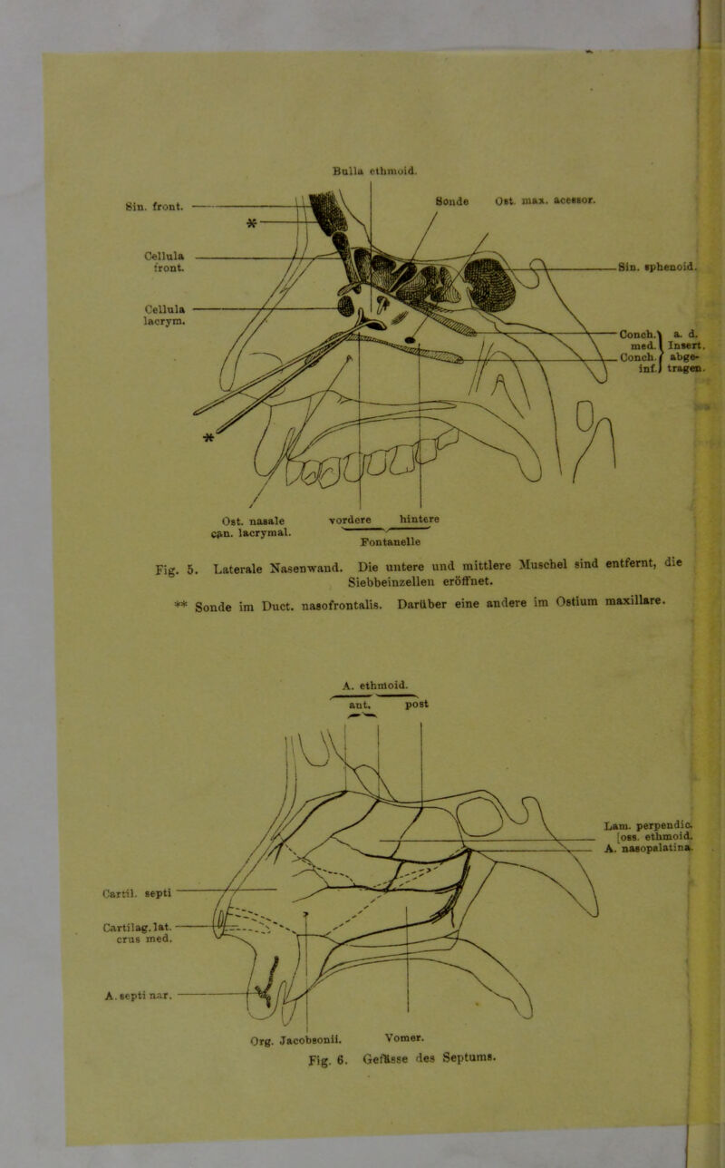 Bulla etbmoid. Bin. front. Cellula front. Cellula lacrym. Sonde Ost. max. acessor. Ost. nasale Cfkn. lacrymal. ■vordere hintere Fontanelle Sin. iphenoid. ConchA a. d. med.I Insert. Conch.« abge- inf.J tragen. Fig. 5. Laterale Na.senwand. Die untere und mittlere Muschel sind entfernt, die Siebbeinzellen eröffnet. ** Sonde im Duct. nasofrontalis. Darüber eine andere im Ostium maxillare.