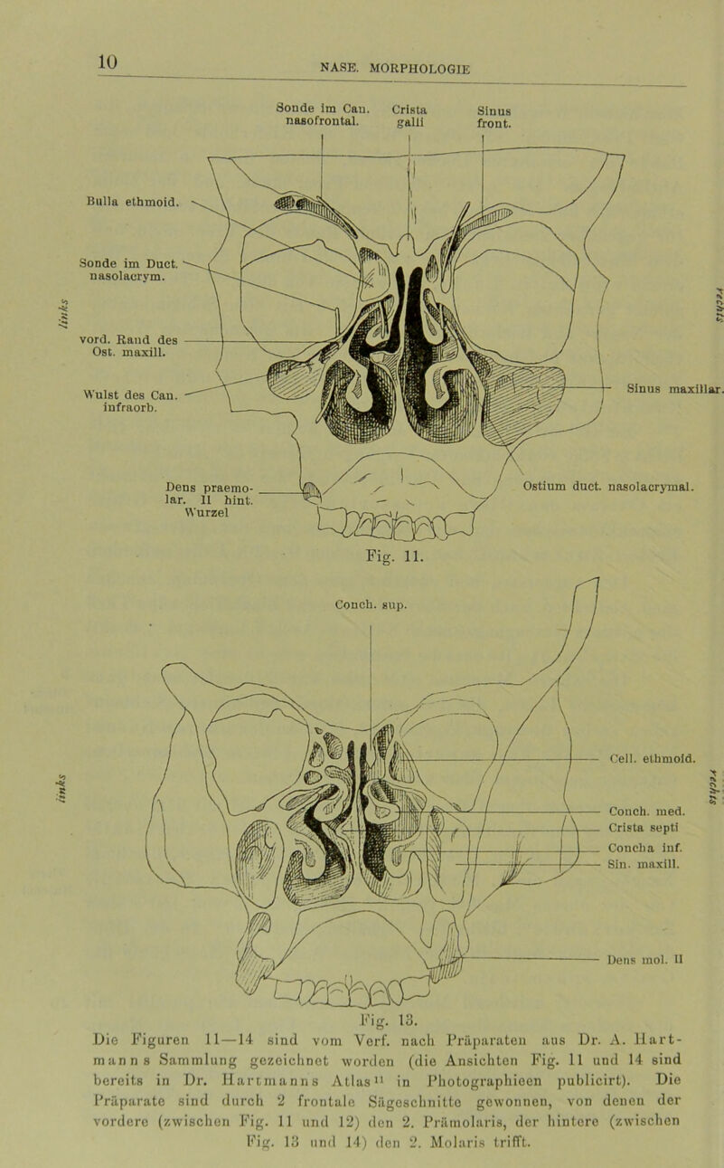 itnks links Sonde im Cau. Crista Sinus nasofrontal. galli front. Bulla ethmoid. Sonde im Duct. nasolaerym. vord. Rand des Ost. maxill. Wulst des Can. iufraorb. Dens praemo- lar. 11 hint. Wurzel Ostium duct. nasolacrymal. Cell, ethmoid. Conch. med. Crista septi Concba inf. Sin. maxill. Dens mol. II Fig. 13. Die Figuren 11—14 sind vom Vorf. nach Präparaten aus Dr. A. llart- manns Sammlung gezeichnet worden (die Ansichten Fig. 11 und 14 sind bereits in Dr. Hartmanns Atlas11 in Photographieen publicirt). Die Präparate sind durch 2 frontale Sägcsehnitto gewonnen, von denen der vordere (zwischen Fig. 11 und 12) den 2. Prämolaris, der hintere (zwischen Fig. 13 und 14) den 2. Molaris trifft.