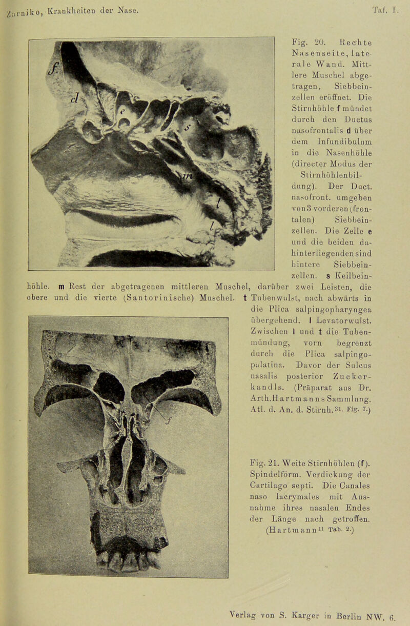 Znrniko, Krankheiten der Nase. Tat. T. Fig. 20. Rechte Nasenseite, late- rale Wand. Mitt- lere Muschel abge- tragen, Siebhein- zellen eröffnet. Die Stirnhöhle f mündet, durch den Ductus nasofrontalis d über dem Infundibulum in die Nasenhöhle (directer Modus der Stirnhöhlenbil- dung). Der Duct. nasofront. umgeben von 3 vorderen (fron- talen) Siebbein- zellen. Die Zelle e und die beiden da- hinterliegenden sind hintere Siebbein- zellen. s Keilbein- höhle. m Rest der abgetragenen mittleren Muschel, darüber zwei Leisten, die obere und die vierte (Santorinische) Muschel. t Tubenwulst, nach abwärts in die Plica salpingopharyngea übergehend. I Levatorwulst. Zwischen I und t die Tuben- mündung, vorn begrenzt durch die Plica salpingo- pulatina. Davor der Sulcus nasalis posterior Zucker- kandis. (Präparat aus Dr. Arth.Hartman ns Sammlung. Atl. d. An. d. Stirnh.st. Fig. 7.) Fig. 21. Weite Stirnhöhlen (f). Spindelförm. Verdickung der Cartilago septi. Die Canales naso lacrymales mit Aus- nahme ihres nasalen Endes der Länge nach getroffen. (Hartmann11 Tab. 2.)
