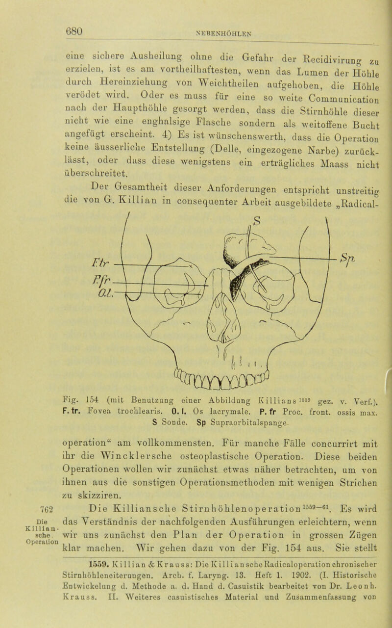 762 Die Killian- sche. Operation 080 eine sichere Ausheilung ohne die Gefahr der Recidivirung zu erzielen, ist es am vorteilhaftesten, wenn das Lumen der Höhle durch Hereinziehung von Weichtheilen aufgehoben, die Höhle verödet wird. Oder es muss für eine so weite Communication nach der Haupthöhle gesorgt werden, dass die Stirnhöhle dieser nicht wie eine enghalsige Flasche sondern als weitoffene Bucht angefügt erscheint. 4) Es ist wünschenswert, dass die Operation keine äusserliche Entstellung (Delle, eingezogene Narbe) zurück- liisst, oder dass diese wenigstens ein erträgliches Maass nicht überschreitet. Der Gesamtheit dieser Anforderungen entspricht unstreitig die von G. Killian in consequenter Arbeit ausgebildete „Radical- Fig. 154 (mit Benutzung einer Abbildung Killians 1559 gez. v. Verf.). F. tr. Fovea trochlearis. 0.1. Os lacrymale. P. fr Proc. front, ossis max. S Sonde. Sp Supraorbitalspange. Operation“ am vollkommensten. Für manche Fälle concurrirt mit ihr die Wincklersehe osteoplastische Operation. Diese beiden Operationen wollen wir zunächst etwas näher betrachten, um von ihnen aus die sonstigen Operationsmethoden mit wenigen Strichen zu skizziren. Die Killiansche Stirnhöhlenoperation 1559-61. Es wird das Verständnis der nachfolgenden Ausführungen erleichtern, wenn wir uns zunächst den Plan der Operation in grossen Zügen klar machen. Wir gehen dazu von der Fig. 154 aus. Sie stellt 1559. Killian&Krauss: Die Kil 1 ian scheRadicaloperation chronischer Stirnhöhleneiterungen. Arch. f. Laryng. 13. Heft 1. 1902. (I. Historische Entwickelung d. Methode a. d. Hand d. Casuistik bearbeitet von Dr. Leonh. Krauss. II. Weiteres casuistisches Material und Zusammenfassung von