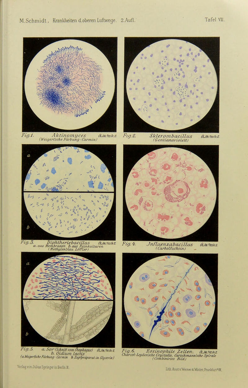 Fig.i. Aktinomyces öumMsOcs. Fig.2. SkLerombacLLlus öUmMsOcZ. [Weigerfsche Färbung-Carminj (G entianavioLett) a. aus Membranen b. aus ReinkuUureTh i ly.f. ^ ru LuenzaüOCUtUS OUm.^Oc.s. (MethyUnblmi Löffltr) ' tarbolfuchsuv) ■''Z %fi,!'Zl'nr'lf^'^' äJM2. Fig. 6 EosirwphiLc ZeUew. öumz. Lith, Anstv.Wenier iWinler.FranWurt'/M.