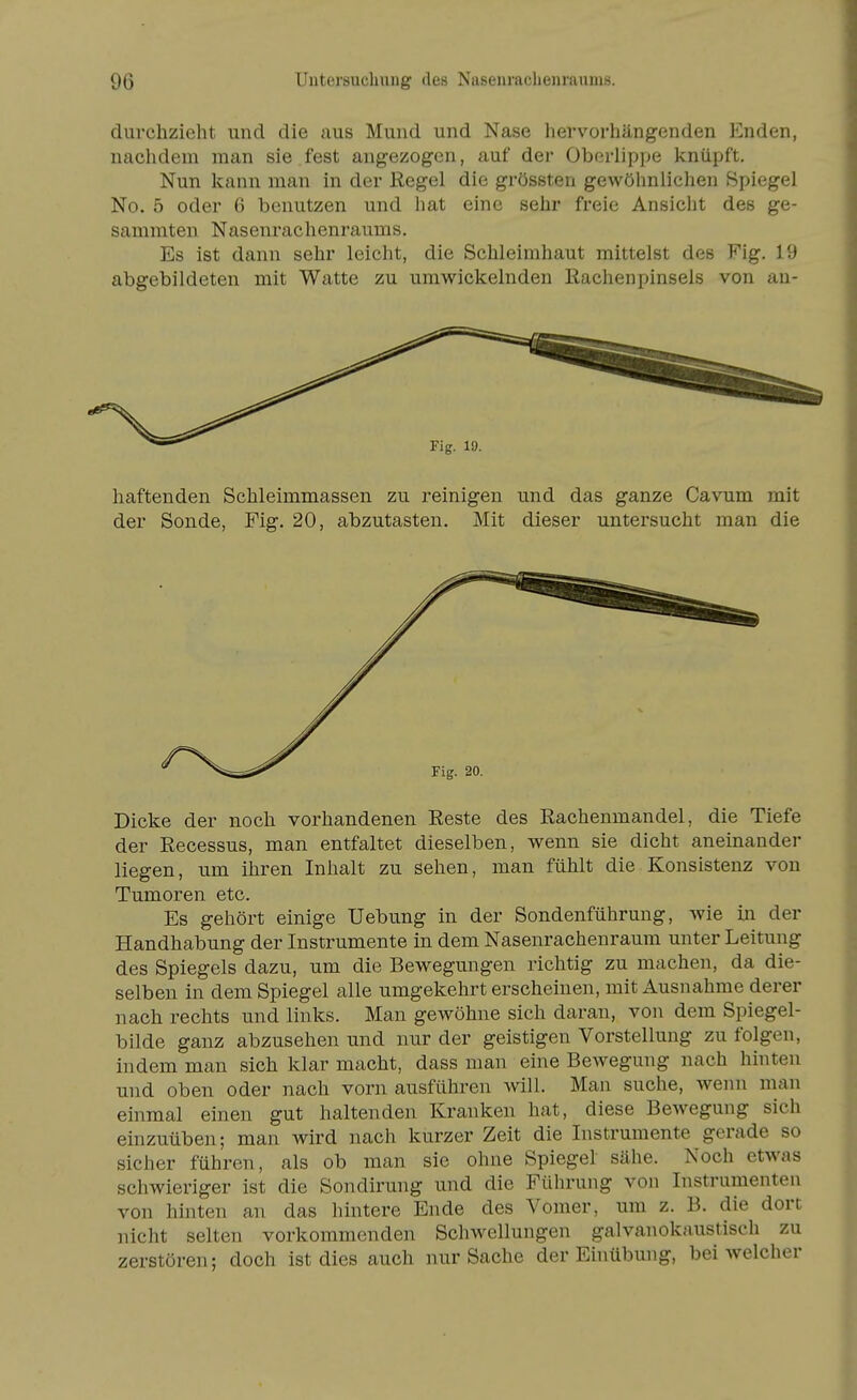 durchzieht und die aus Mund und Nase hervorhängenden Enden, nachdem man sie fest angezogen, auf der Oborlipjje knüpft. Nun kann man in der Regel die grössteu gewölmliehen Spiegel No. 5 oder 6 benutzen und hat eine sehr freie Ansicht des ge- sammten Nasenrachenraums, Es ist dann sehr leicht, die Schleimhaut mittelst des Fig. 19 abgebildeten mit Watte zu umwickelnden Rachenpinsels von an- haftenden Schleimmassen zu reinigen und das ganze Cavum mit der Sonde, Fig. 20, abzutasten. Mit dieser untersucht man die Dicke der noch vorhandenen Reste des Rachenmandel, die Tiefe der Recessus, man entfaltet dieselben, wenn sie dicht aneinander liegen, um ihren Inhalt zu sehen, man fühlt die Konsistenz von Tumoren etc. Es gehört einige Uebung in der Sondenführung, wie in der Handhabung der Instrumente in dem Nasenrachenraum unter Leitung des Spiegels dazu, um die Bewegungen richtig zu machen, da die- selben in dem Spiegel alle umgekehrt erscheinen, mit Ausnahme derer nach rechts und links. Man gewöhne sich daran, von dem Spiegel- bilde ganz abzusehen und nur der geistigen Vorstellung zu folgen, indem man sich klar macht, dass man eine Bewegung nach hinten und oben oder nach vorn ausführen will. Man suche, wenn man einmal einen gut haltenden Kranken hat, diese Bewegung sich einzuüben; man wird nach kurzer Zeit die Instrumente gerade so sicher führen, als ob man sie ohne Spiegel sähe. Noch etwas schwieriger ist die Sondirung und die Führung von Instrumenten von hinten an das hintere Ende des Vomer, um z. B. die dort nicht selten vorkommenden Schwellungen galvanokaustisch zu zerstören; doch ist dies auch nur Sache der Einübung, bei welcher