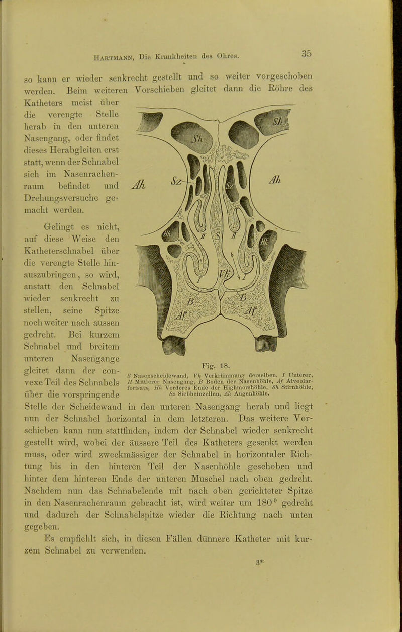 Gelingt es nicht, auf diese Weise den Kathetersclmabel über die verengte Stelle liin- auszubringen, so wird, anstatt den Schnabel wieder senkrecht zu stellen, seine Spitze noch weiter nach aussen gedreht. Bei kurzem Schnabel und breitem unteren Nasengange gleitet dann der con- vexe Teil des Schnabels über die vorspringende Stelle der Scheidewand in den unteren Nasengang herab und liegt nun der Schnabel horizontal in dem letzteren. Das weitere Vor- schieben kann nun stattfinden, indem der Schnabel wieder senkrecht gestellt wird, wobei der äussere Teil des Katheters gesenkt werden muss, oder wird zweckmässiger der Schnabel in horizontaler Rich- tung bis in den hinteren Teil der Nasenhöhle geschoben und hinter dem hinteren Ende der unteren Muschel nach oben gedreht. Nachdem nun das Schnabelende mit nach oben gerichteter Spitze in den Nasenrachenraum gebracht ist, wird weiter um 180° gedreht und dadurch der Schnabelspitze wieder die Richtung nach unten gegeben. Es empfiehlt sich, in diesen Fällen dünnere Katheter mit kur- zem Schnabel zu verwenden. Fig. 18. S Nasensclieidewand, Vlc Verkrümmung derselben. I Unterer, II Mittlerer Nasengang, B Boden der Nasenhöhle, Af Alveolar- fortsatz, Rh Vorderes Ende der Highmorsliöhle, Sh Stirnhöhle, Sz Siebbeinzellen, Ah Augenhöhle. so kann er wieder senkrecht gestellt und so weiter vorgeschoben werden. Beim weiteren Vorschieben gleitet dann die Röhre des Katheters meist über die verengte Stelle herab in den unteren Nasengang, oder findet dieses Herabgleiten erst statt, wenn der Schnabel sicli im Nasenrachen- raum befindet und Drehungsversuche ge- macht -werden. 3*