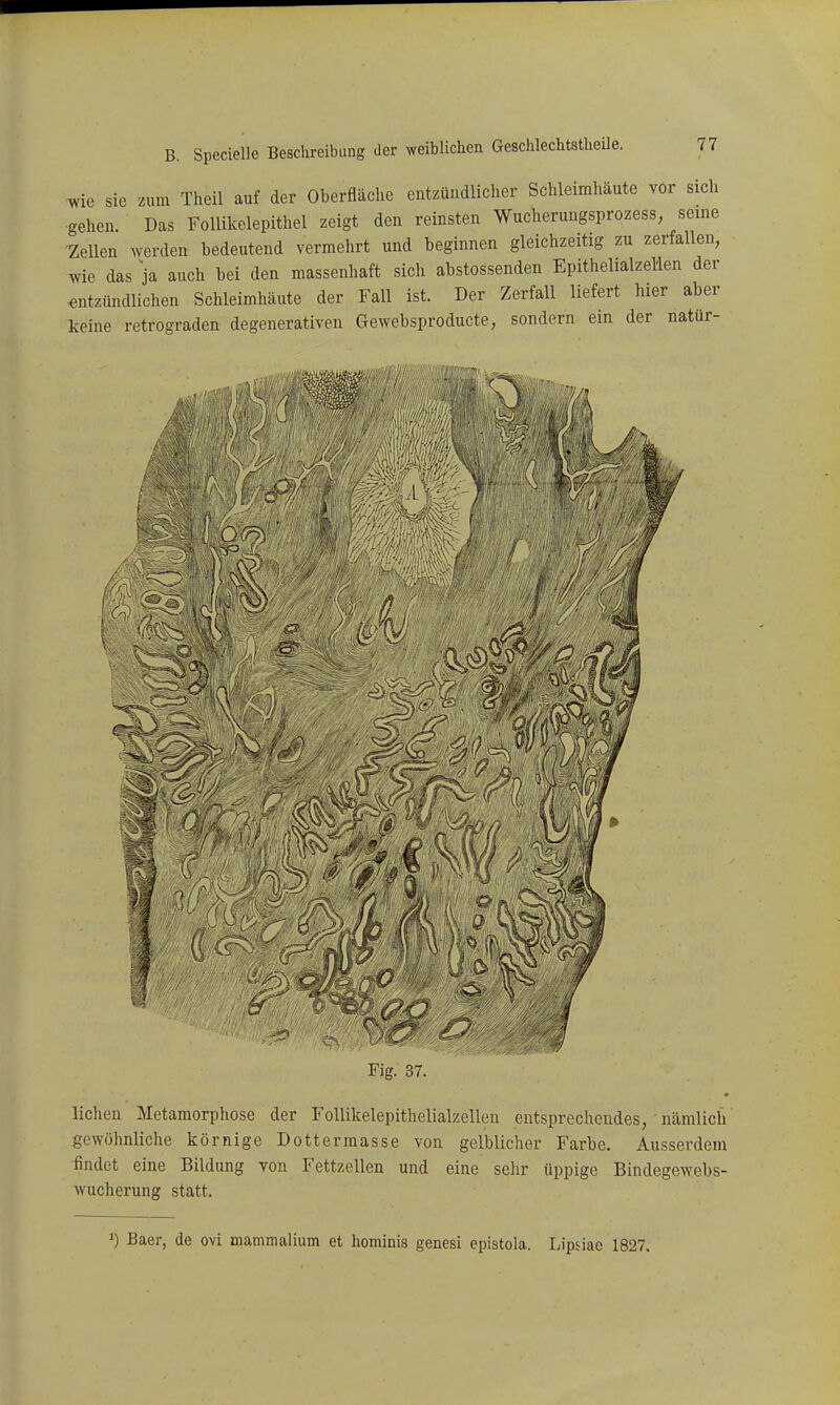 wie sie zum Theil auf der Oberfläche entzündliclier Schleimhäute vor sich gehen. Das Follikelepithel zeigt den reinsten Wucherungsprozess seine IZellen werden bedeutend vermehrt und beginnen gleichzeitig zu zerfallen, wie das ja auch bei den massenhaft sich abstossenden Epithelialzelien der ■entzündlichen Schleimhäute der Fall ist. Der Zerfall liefert hier aber keine retrograden degenerativen Gewebsproducte, sondern ein der natür- ß& ('iW^i Fig. 37. liehen Metamorphose der Follikelepithelialzellen entsprechendes,'nämlich' gewöhnliche körnige Dottermasse von gelblicher Farbe. Ausserdem findet eine Bildung von Fettzellen und eine sehr üppige Bindegewebs- wucherung statt. 1) Baer, de ovi mammalium et hominis genesi epistola. Lipsiae 1827.