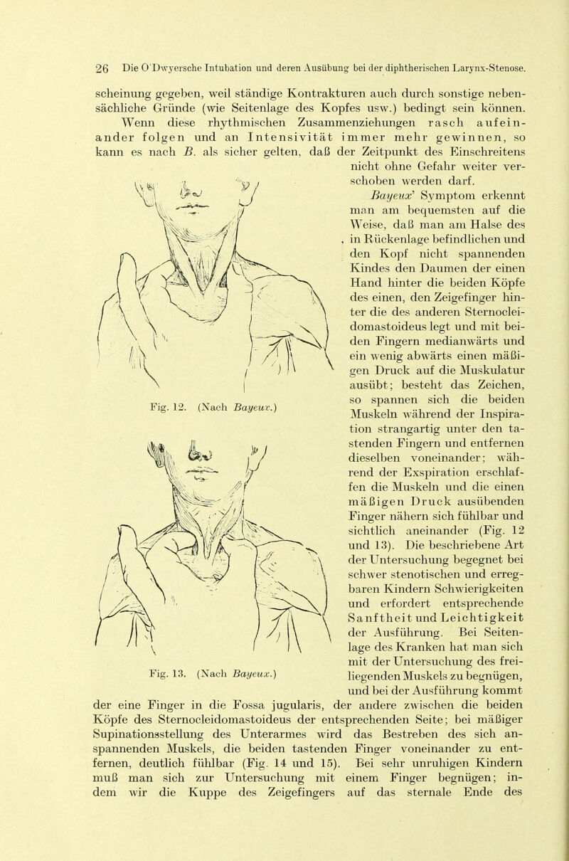 Fig. 12. (Nach Bayeux.) scheinung gegeben, weil ständige Kontrakturen auch durch sonstige neben- sächliche Gründe (wie Seitenlage des Kopfes usw.) bedingt sein können. Wenn diese rhythmischen Zusammenziehungen rasch aufein- ander folgen und an Intensivität immer mehr gewinnen, so kann es nach B. als sicher gelten, daß der Zeitpunkt des Einschreitens nicht ohne Gefahr weiter ver- schoben werden darf. Bayetix' Symptom erkennt man am bequemsten auf die Weise, daß man am Halse des in Rückenlage befindlichen und den Kopf nicht spannenden Kindes den Daumen der einen Hand hinter die beiden Köpfe des einen, den Zeigefinger hin- ter die des anderen Sternoclei- domastoideus legt und mit bei- den Fingern medianwärts und ein wenig abwärts einen mäßi- gen Druck auf die Muskulatur ausübt; besteht das Zeichen, so spannen sich die beiden Muskeln während der Inspira- tion strangartig unter den ta- stenden Fingern und entfernen dieselben voneinander; wäh- rend der Exspiration erschlaf- fen die Muskeln und die einen mäßigen Druck ausübenden Finger nähern sich fühlbar und sichtlich aneinander (Fig. 12 und 13). Die beschriebene Art der Untersuchung begegnet bei schwer stenotischen und erreg- baren Kindern Schwierigkeiten und erfordert entsprechende Sanftheit und Leichtigkeit der Ausführung. Bei Seiten- lage des Kranken hat man sich mit der Untersuchung des frei- liegenden Muskels zu begnügen, und bei der Ausführung kommt der eine Finger in die Fossa jugularis, der andere zwischen die beiden Köpfe des Sternocleidomastoideus der entsprechenden Seite; bei mäßiger Supinationsstellung des Unterarmes wird das Bestreben des sich an- spannenden Muskels, die beiden tastenden Finger voneinander zu ent- fernen, deutlich fühlbar (Fig. 14 und 15). Bei sehr unruhigen Kindern muß man sich zur Untersuchung mit einem Finger begnügen; in- dem wir die Kuppe des Zeigefingers auf das sternale Ende des (Nach Bayeux.)