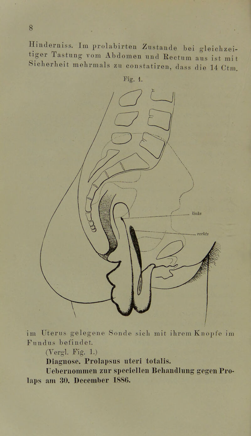 Hinderuiss. Im prolabirteu Zustande bei -leichzei- tiger Tastung' vom Abdomen und Rectum aus ist mit Sicherheit mehrmals zu constatiren, dass die 14 Ctm Fig. 1. im Uterus gelegene Sonde sich mit ihrem Knopfe im Fundus befindet. (Yergl. Fig. 1.) Diagnose. Prolapsus uteri totalis, üeberuonimeii zur speciellen Behaudlung gegen Pro- laps am 30. December 1886.