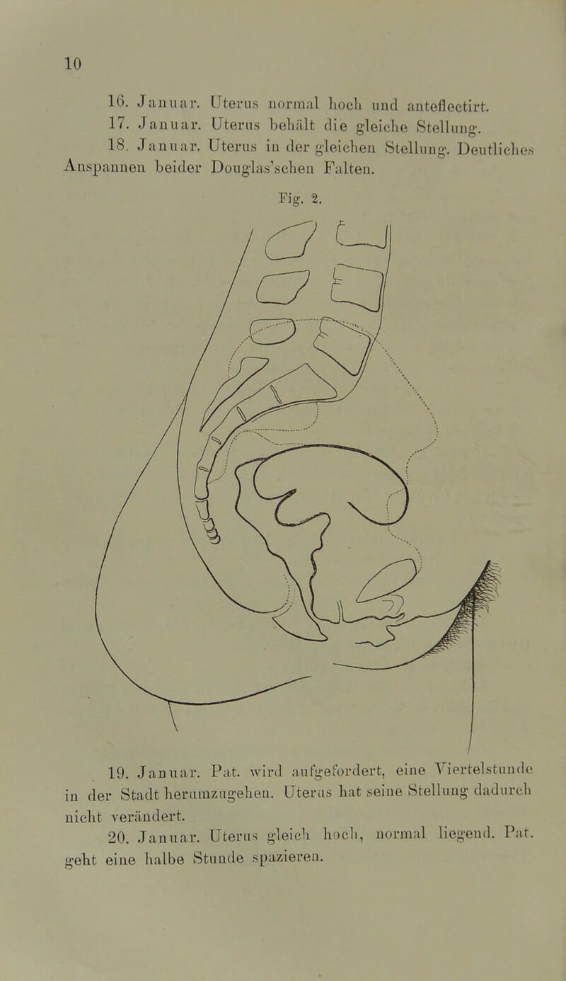 16. Januar. Uterus uormal liocli und auteflectirt. 17. Januar, Uterus behält die gleiche Stellung. 18. Januar. Uterus in dergleichen Stellung. Deutliches Auspannen beider Douglas'schen Falten. Fig. 2. 19. Januar. Pat. wird aufgefordert, eine Viertelstunde in der Stadt herumzugehen. Uterus hat seine Stellung dadurch uiclit verändert. 20. Januar. Uterus gleich hoch, normal liegend. Pat. geht eine halbe Stunde spazieren.