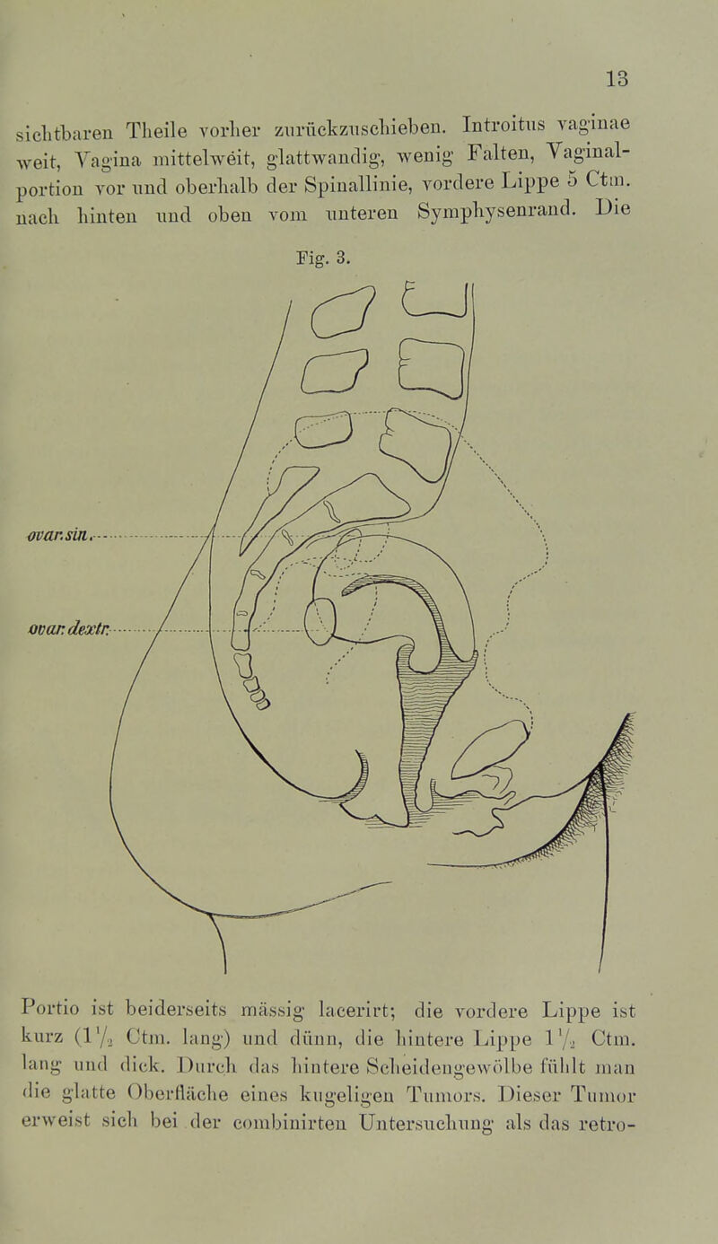 siclitbaren Theile vorlier ziirückznscliieben. Introitiis vaginae weit, Vagina mittelweit, glattwandig, wenig Falten, Vaginal- portion vor und oberlialb der Spiuallinie, vordere Lippe 5 Ctm. nach hinten und oben vom unteren Symphysenrand. Die Fig. 3. mar.sui. ovar.dextr, Portio ist beiderseits massig lacerirt; die vordere Lippe ist kurz (ly.. Ctm. lang) und dünn, die hintere Lippe 1'/, Ctm. lang und dick. Durch das hintere Scheidengewölbe fühlt man die glatte Oberfläche eines kugeligen Tumors. Dieser Tumor erweist sich bei der combinirten Untersuchung als das retro-