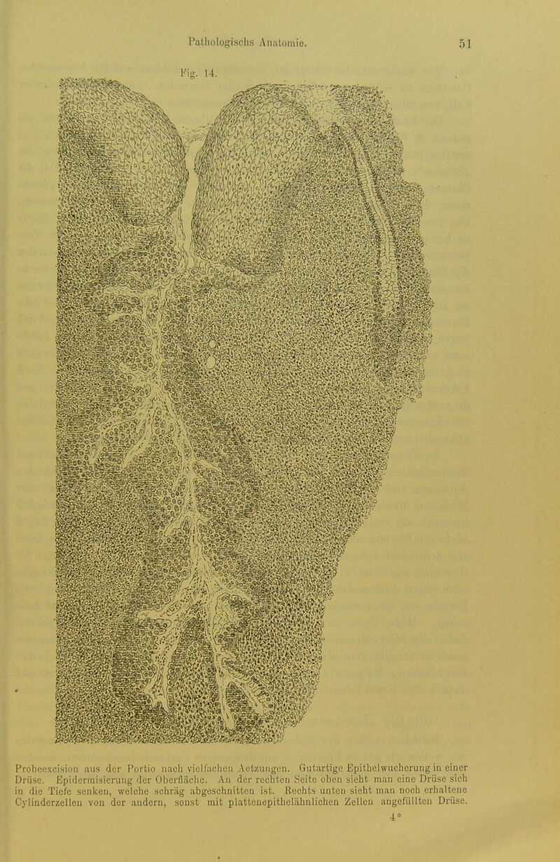 Probeexcision aus der Portio nach viciraehon Aetzungcn. Gutartige Epithelwucherung in einer Drüse. EpiderinisieruMg der Übcriläche. An der rechten Seite oben sieht man eine Drüse sich in die Tiefe senlten, welche schräg abgeschnitten ist. Rechts unten sieht man noch erhaltene Cylindcrzellcü von der andern, sonst mit platteuepithelähnlichen Zellen augefüllten Drüse.