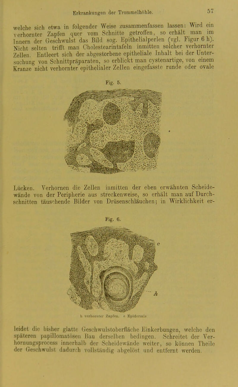 welche sich etwa in folgender Weise zusammenfassen lassen: Wird ein verhornter Zapfen quer vom Schnitte getroffen, so erhält man im Innern der Geschwulst das Bild sog. Epithelialperlen (vgl. Figur 6 h). Nicht selten trifft man Cholestearintafeln inmitten solcher verhornter Zellen. Entleert sich der abgestorbene epitheliale Inhalt bei der Unter- suchung von Schnittpräparaten, so erblickt man cystenartige, von einem Kranze^nicht verhornter epithelialer Zellen eingefasste runde oder ovale Fig. 5. Lücken. Verhornen die Zellen inmitten der eben erwähnten Scheide- wände von der Peripherie aus streckenweise, so erhält man auf Durch- schnitten täuschende Bilder von Drüsenschläuchen; in Wirklichkeit er- Fig. 6. Ii verhornter Zapfen, c Epidermis leidet die bisher glatte Geschwulstoberfläche Einkerbungen, welche den späteren papillomatösen Bau derselben bedingen. Schreitet der Ver- hornungsprocess innerhalb der Scheidewände weiter, so können Theile der Geschwulst dadurch vollständig abgelöst und entfernt werden.