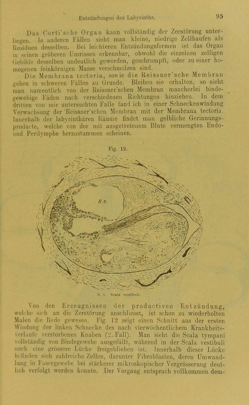 Das Corti'scho Organ kann vollständig der Zerstörung unter- ließen. In anderen Fällen sieht man kleine, niedrige Zollhaufen als Residuen desselben. Bei leichteren Entzündungsformen ist das Organ in seinen gröberen Umrissen erkennbar, obwohl die einzelnen zeitigen Gebilde desselben undeutlich geworden, geschrumpft, oder zu einer ho- mogenen feinkörnigen Masse verschmolzen sind. Die Membrana tectoria, sowie die Reissner sehe Membran gehen in schweren Fällen zu Grunde. Bleiben sie erhalten, so sieht man namentlich von der Reissne Eschen Membran mancherlei binde- gewebige Fäden nach verschiedenen Richtungen hinziehen. In dem dritten von mir untersuchten Falle fand ich in einer Schneckenwindung Verwachsung der 'Reissnersehen Membran mit der Membrana tectoria. Innerhalb der labyrinthäron Räume findet man gelbliche Gerinnungs- producte, welche von der mit ausgetretenem Blute vermengten Endo- und Perilymphe herzustammen scheinen. Fig. 12. Von den Erzeugnissen der productiven Entzündung, welche sich an die Zerstörung ansohliesst, ist schon zu wiederholten Malen die Rede gewesen. Fig. 12 zeigt einen Schnitt aus der ersten Windung der linken Schnecke des nach vierwöchentlichem Krankheits- verlaufe verstorbenen Knaben (2. Fall). Man sieht die Scala tympani vollständig von Bindegewebe ausgefüllt, während in der Scala vestibuli noch eine grössere Lücke frcigcbliebcn ist. Innerhalb dieser Lücke befinden sich zahlreiche Zellen, darunter Fibroblasten, deren Umwand- lung in l asergewebe bei stärkerer mikroskopischer Vergrösserung deut- lich verfolgt werden konnte. Der Vorgang entsprach vollkommen dem-