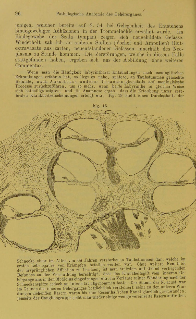 jeiligen, welcher bereits auf S. 54 bei Gelegenheit des Entstehens bindegewebiger Adhäsionen in der Trommelhöhle erwähnt wurde. Im Bindegewebe der Scala tympani zeigen sich neugebildcte Gefässe. Wiederholt sah ich an anderen Stellen (Vorhof und Ampullen) Blut- extravasate aus zarten, neuentstandenen Gefässen innerhalb des Nco- plasma zu Stande kommen. Die Zerstörungen, welche in diesem Falle stattgefunden haben, ergeben sich aus der Abbildung ohne weiteren Com mentar. Wenn man die Häufigkeit labyrinthärer Entzündungen nach meningitischen Erkrankungen erfahren hat, so liegt es nahe, spätere, an Taubstummen gemachte Befunde, nach Ausschluss anderer Ursachen gleichfalls auf meningitische Processe zurückzuführen, um so mehr, wenn beide Labyrinthe in gleicher Weise sich betheiligt zeigten, und die Anamnese ergab, dass die Ertaubung unter cere- bralen Krankheitserscheinungen erfolgt war. Fig. 13 stellt einen Durchschnitt der Fig. 13. Schnecke einer im Alter von G8 Jahren verstorbenen Taubstummen dar, welche im ersten Lebensjahre von Krämpfen befallen worden war. Ohne weitere Kenntmss der ursprünglichen Affection zu besitzen, ist man trotzdem auf Grund vorliegenden Befundes zu der Vermuthung berechtigt, dass das Krankheitsgift vom inneren Ge- hörgange aus in den Modiolus eingedrungen war, im Verlaufe seiner Wanderung nach der Sch necken.spitze jedoch an Intensität abgenommen hatte. Der Stamm des N. acust war im Grunde des inneren Gehörganges beträchtlich verkleinert, seine zu den unteren Win- dungen ziehenden Fasern waren bis zum Rosentlial’sclien Kanal gänzlich geschwunden; jenseits der Gangliengruppe sieht man wieder einige wenige vereinzelte Fasern auftreten.