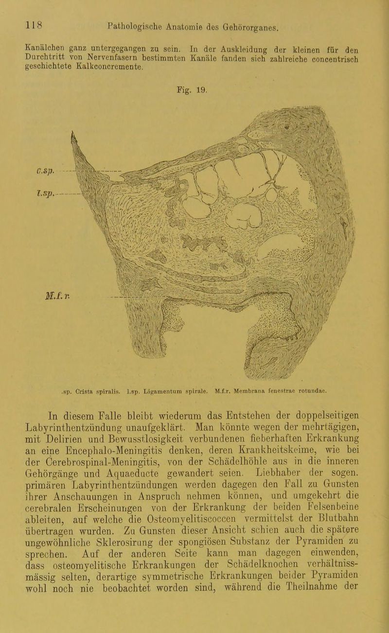 Kanälchen ganz untergegangen zu sein. In der Auskleidung der kleinen für den Durchtritt von Nervenfasern bestimmten Kanäle fanden sich zahlreiche concentrisch geschichtete Kalkconcremente. Fig. 19. .sp. Crista spiralig, l.sp. Ligamentum spirale. M.f.r. Membrana fenestrae rotundae. In diesem Falle bleibt wiederum das Entstehen der doppelseitigen Labyrinthentzündung unaufgeklärt. Man könnte wegen der mehrtägigen, mit Delirien und Bewusstlosigkeit verbundenen fieberhaften Erkrankung an eine Encephalo-Meningitis denken, deren Krankheitskeime, wie bei der Cerebrospinal-Meningitis, von der Schädelhöhle aus in die inneren Gehörgänge und Aquaeducte gewandert seien. Liebhaber der sogen, primären Labyrinthentzündungen werden dagegen den Fall zu Gunsten ihrer Anschauungen in Anspruch nehmen können, und umgekehrt die cerebralen Erscheinungen von der Erkrankung der beiden Felsenbeine ableiten, auf welche die Osteomyelitiscoccen vermittelst der Blutbahn übertragen wurden. Zu Gunsten dieser Ansicht schien auch die spätere ungewöhnliche Sklerosirung der spongiösen Substanz der Pyramiden zu sprechen. Auf der anderen Seite kann man dagegen einwenden, dass osteomyelitische Erkrankungen der Schädelknochen verhältniss- mässig selten, derartige symmetrische Erkrankungen beider Pyramiden wohl noch nie beobachtet worden sind, während die Theilnahme der