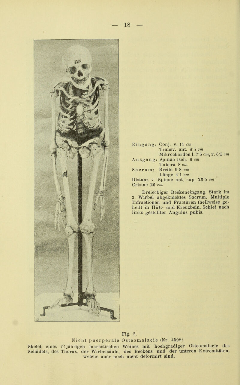 Eingang: Conj. v. 11 cm Transv. ant. 8 5 cm Mikrochorden 1. 7*5 cm, r. 6'5 cm Ausgang: Spinae iseh. 6 cm Tubera 8 cm Sacrum: Breite 9'8 cm Länge 41 cm Distanz v. Spinae ant. sup. 23'5 cm Cristae 26 cm Dreieckiger Beckeneingang. Stark im 2. Wirbel abgeknicktes Sacrum. Multiple Infractionen und Fracturen theilweise ge- heilt in Hüft- und Kreuzbein. Schief nach links gestellter Angulus pubis. Fig. 2. Nicht puerperale Osteomalaeie (Nr. 4598). Skelet eines 51jährigen marastischen Weibes mit hochgradiger Osteomalaeie des Schädels, des Thorax, der Wirbelsäule, des Beckens und der unteren Extremitäten, welche aber noch nicht deformirt sind.