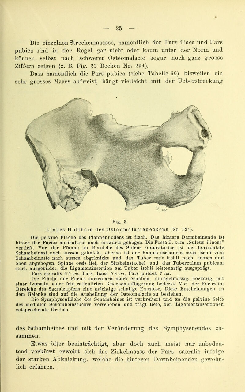 Die einzelnen Streckenmaasse, namentlicli der Pars iliaca und Pars pubica sind in der Regel gar nicht oder kaum unter der Norm und können selbst nach schwerer Osteomalacie sogar noch ganz grosse Ziffern zeigen (z. B. Fig. 22 Becken Nr. 294). Dass namentlich die Pars pubica (siehe Tabelle 60) bisweilen ein sehr grosses Maass aufweist, hängt vielleicht mit der Ueberstreckung Fig. 3. Linkes Hüftbein des Oste omalaciebeckens (Nr. 324). Die pelvine Fläche des Pfannenbodens ist flach. Das hintere Darmbeinende ist hinter der Facies auricularis nach einwärts gebogen. Die Fossa il. zum „Sulcus iliacus vertieft. Vor der Pfanne im Bereiche des Sulcus obturatorius ist der horizontale Schambeinast nach aussen geknickt, ebenso ist der Ramus ascendens ossis ischii vom Schambeinaste nach aussen abgeknickt und das Tuber ossis ischii nach aussen und oben abgebogen. Spinae ossis ilei, der Sitzbeinstachel und das Tuberculum pubicum stark ausgebildet, die Ligamentinsertion am Tuber ischii leistenartig ausgeprägt. Pars sacralis 6'5 cm, Pars iliaca 5*8 cm. Pars pubica 7 cm. Die Fläche der Facies auricularis stark erhalaen, unregelmässig, höckerig, mit einer Lamelle einer fein reticulirten Knochenauflagerung bedeckt. Vor der Facies im Bereiche des Sacralzapfens eine mächtige schalige Exostose. Diese Erscheinungen an dem Gelenke sind auf die Ausheilung- der Osteomalacie zu beziehen. Die Symphysenfläche des Schambeines ist verbreitert und an die pelvine Seite des medialen Schambeinstückes verschoben und trägt tiefe, den Ligamentinsertionen entsprechende Gruben. des Schambeines und mit der Veränderung des Symphysenendes zu- sammen. Etwas öfter beeinträchtigt, aber doch auch meist nur unbedeu- tend verkürzt erweist sich das Zirkelmaass der Pars sacralis infolge der starken Abknickung, welche die hinteren Darmbeinenden gewöhn- lich erfahren.