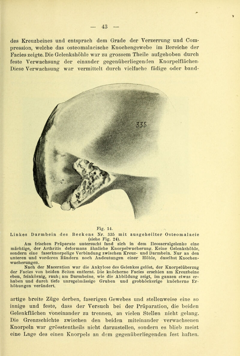 des Kreuzbeines und entsprach dem Grade der Verzerrung und Com- pression, welche das osteomalacische Knochengewebe im Bereiche der Facies zeigte. Die Gelenkshöhle war zu grossem Theile aufgehoben durch feste Verwachsung der einander gegenüberliegenden Knorpelflächen- Diese Verwachsung war vermittelt durch vielfache fädige oder band- Fig. 14. Linkes Darmbein des Beckens Nr. 335 mit ausgeheilter Osteomalacie (siehe Fig. 24). Am frischen Präparate untersucht fand sich in dem Ileosacralgelenke eine mächtige, der Arthritis deformans ähnliche Knorpelwucherung. Keine Gelenkshöhle, sondern eine faserknorpelige Verbindung zwischen Kreuz- und Darmbein. Nur an den unteren und vorderen Rändern noch Andeutungen einer Höhle, daselbst Knochen- wucherungen. Nach der Maceration war die Ankylose des Gelenkes gelöst, der Knorpelüberzug der Facies von beiden Seiten entfernt. Die knöcherne Facies erschien am Kreuzbeine eben, feinkörnig, rauh; am Darmbeine, wie die Abbildung zeigt, im ganzen etwas er- haben und durch tiefe unregelmässige Gruben und grobhöckerige knöcherne Er- höhungen verändert. artige breite Züge derben, faserigen Gewebes und stellenweise eine so innige und feste, dass der Versuch bei der Präparation, die beiden Gelenkflächen voneinander zu trennen, an vielen Stellen nicht gelang. Die Grenzschichte zwischen den beiden miteinander verwachsenen Knorpeln war grösstentheils nicht darzustellen, sondern es blieb meist eine Lage des einen Knorpels an dem gegenüberliegenden fest haften.