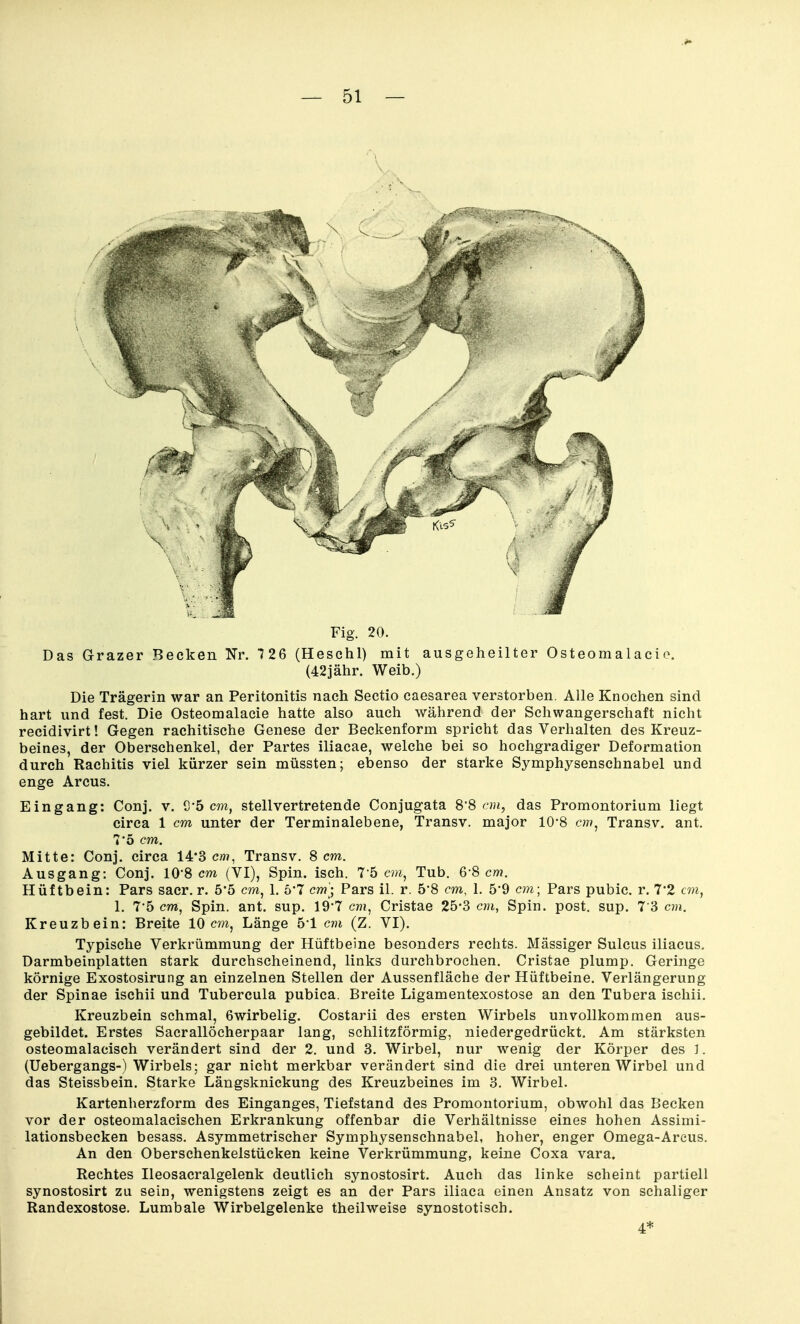 Fig. 20. Das Grazer Becken Nr. 7 26 (Heschl) mit ausgeheilter Osteomalacio. (42jähr. Weib.) Die Trägerin war an Peritonitis nach Sectio caesarea verstorben. Alle Knochen sind hart und fest. Die Osteomalacie hatte also auch während der Schwangerschaft nicht recidivirt! Gegen rachitische Genese der Beckenform spricht das Verhalten des Kreuz- beines, der Oberschenkel, der Partes iliacae, welche bei so hochgradiger Deformation durch Rachitis viel kürzer sein müssten; ebenso der starke Symphysenschnabel und enge Arcus. Eingang: Conj. v. Ö'ö cw, stellvertretende Conjugata S'8 cm, das Promontorium liegt circa 1 cm unter der Terminalebene, Transv. major 10*8 e???, Transv. ant. 7'5 cm. Mitte: Conj. circa 14'3 cm, Transv. 8 cm. Ausgang: Conj. 10'8 cm (VI), Spin. isch. l'b cm^ Tub. 6*8 cw. Hüftbein: Pars sacr. r. 5'5 cm, 1. 5*7 cm; Pars iL r. 5*8 cm, 1. 5*9 cm; Pars pubic. r. 7'2 an, 1. 7*5 cm, Spin. ant. sup. 19'7 cwi, Cristae 25-3 cm, Spin. post. sup. 7 3 cm. Kreuzbein: Breite 10 cm^ Länge 5-1 cm (Z. VI). Typische Verkrümmung der Hüftbeine besonders rechts. Mässiger Sulcus iliacus. Darmbeinplatten stark durchscheinend, links durchbrochen. Cristae plump. Geringe körnige Exostosirung an einzelnen Stellen der Aussenfläche der Hüftbeine. Verlängerung der Spinae ischii und Tubercula pubica. Breite Ligamentexostose an den Tubera ischii. Kreuzbein schmal, Gwirbelig. Costarii des ersten Wirbels unvollkommen aus- gebildet. Erstes Sacrallöcherpaar lang, schlitzförmig, niedergedrückt. Am stärksten osteomalacisch verändert sind der 2. und 3. Wirbel, nur wenig der Körper des ]. (Uebergangs-) Wirbels; gar nicht merkbar verändert sind die drei unteren Wirbel und das Steissbein. Starke Längsknickung des Kreuzbeines im 3. Wirbel. Kartenherzform des Einganges, Tiefstand des Promontorium, obwohl das Becken vor der osteomalacischen Erkrankung offenbar die Verhältnisse eines hohen Assimi- lationsbecken besass. Asymmetrischer Symphysenschnabel, hoher, enger Omega-Areus. An den Oberschenkelstücken keine Verkrümmung, keine Coxa vara. Rechtes Ileosacralgelenk deutlich synostosirt. Auch das linke scheint partiell synostosirt zu sein, wenigstens zeigt es an der Pars iliaca einen Ansatz von schaliger Randexostose. Lumbale Wirbelgelenke theilweise synostotisch. 4*