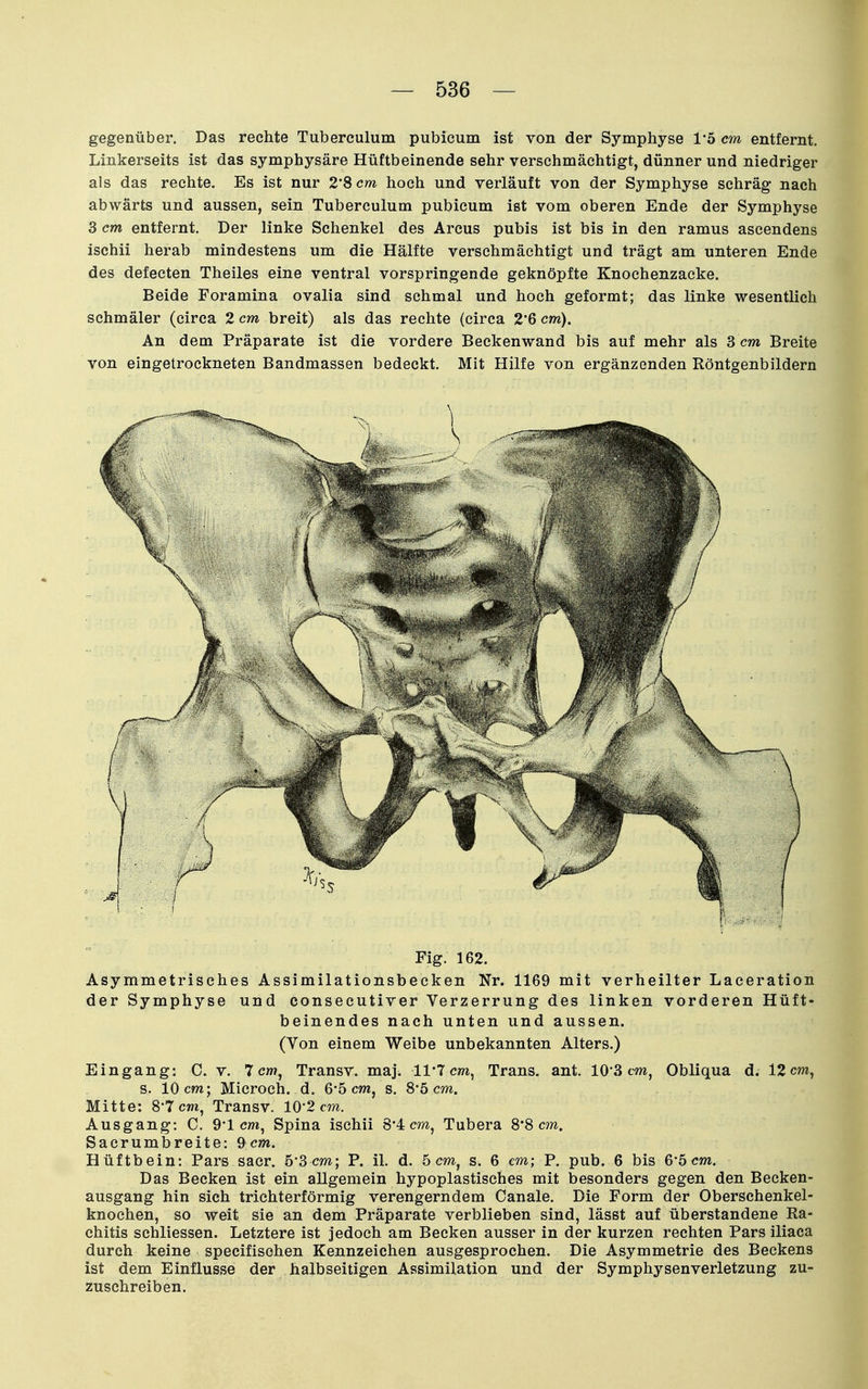 gegenüber. Das rechte Tuberculum pubicum ist von der Symphyse 1*5 cm entfernt. Linkerseits ist das symphysäre Hüftbeinende sehr verschmächtigt, dünner und niedriger als das rechte. Es ist nur 2*8 cm. hoch und verläuft von der Symphyse schräg nach abwärts und aussen, sein Tuberculum pubicum ist vom oberen Ende der Symphyse 3 cm entfernt. Der linke Schenkel des Arcus pubis ist bis in den ramus ascendens ischii herab mindestens um die Hälfte verschmächtigt und trägt am unteren Ende des defecten Theiles eine ventral vorspringende geknöpfte Knochenzacke. Beide Foramina ovalia sind schmal und hoch geformt; das linke wesentlich schmäler (circa 2 cm breit) als das rechte (circa 2*6 cm). An dem Präparate ist die vordere Beckenwand bis auf mehr als 3 cm Breite von eingetrockneten Bandmassen bedeckt. Mit Hilfe von ergänzenden Röntgenbildern Fig. 162. Asymmetrisches Assimilationsbecken Nr. 1169 mit verheilter Laceration der Symphyse und consecutiver Verzerrung des linken vorderen Hüft- beinendes nach unten und aussen. (Von einem Weibe unbekannten Alters.) Eingang: C. v. 7 cw?, Transv. maj. 11'7 cm, Trans, ant. 10*3 cm, Obliqua d. 12 cm, s. 10 cm; Microeh. d. 6-5 cm, s. 8*5 cm. Mitte: 8*7 cm, Transv. 10*2 cm. Ausgang: C. 9'1 cm, Spina ischii 8*4 cm, Tubera 8*8 cm. Sacrumbreite: 9cm. Hüftbein: Pars sacr. 5*3 cm; P. iL d. 5 cm, s. 6 cm; P. pub. 6 bis 6'5 cm. Das Becken ist ein allgemein hypoplastisches mit besonders gegen den Becken- ausgang hin sich trichterförmig verengerndem Canale. Die Form der Oberschenkel- knochen, so weit sie an dem Präparate verblieben sind, lässt auf überstandene Ra- chitis schliessen. Letztere ist jedoch am Becken ausser in der kurzen rechten Pars iliaca durch keine specifischen Kennzeichen ausgesprochen. Die Asymmetrie des Beckens ist dem Einflüsse der halbseitigen Assimilation und der Symphysenverletzung zu- zuschreiben.