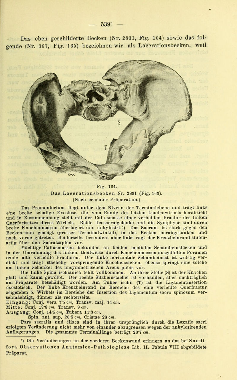 Das eben geschilderte Becken (Nr. 2831, Fig. 164) sowie das fol- gende (Nr. 367, Fig. 165) bezeichnen wir als Lacerationsbecken, weil Fig. 104. Das Lacerationsbecken Nr. 2831 (Fig. 163). (Nach erneuter Präparation.) Das Promontorium liegt unter dem Niveau der Terminalebene und trägt links e'ne breite schalige Exostose, die vom Rande des letzten Lendenwirbels herabzieht und in Zusammenhang steht mit der Callusmasse einer verheilten Fractur des linken Querfortsatzes dieses Wirbels, Beide Ileosaeralgelenke und die Symphyse sind durch breite Knochenmassen überlagert und ankylosirt, i) Das Sacrum ist stark gegen den Beckenraum geneigt (grosser Terminalwinkel), in das Becken herabgesunken und nach vorne getreten. Beiderseits, besonders aber links ragt der Kreuzbeinrand stufen- artig über den Sacralzapfen vor. Mächtige Callusmassen bekunden an beiden medialen Schambeinstücken und in der Umrahmung des linken, theilweise durch Knochenmassen ausgefüllten Foramen ovale alte verheilte Fracturen. Der linke horizontale Schambeinast ist wulstig ver- dickt und trägt stachelig vorspringende Knochenzacken, ebenso springt eine solche am linken Schenkel des unsymmetrischen Arcus pubis vor. Die linke Spina ischiadica fehlt vollkommen. An ihrer Stelle (S) ist der Knochen glatt und kaum gewölbt. Der rechte Sitzbeinstachel ist vorhanden, aber nachträglich am Präparate beschädigt worden. Am Tuber ischii (T) ist die Ligamentinsertion exostotisch. Der linke Kreuzbeinrand im Bereiche des eine verheilte Querfractur zeigenden 5. Wirbels im Bereiche der Insertion des Ligamentum sacro spinosum ver- schmächtigt, dünner als rechterseits. Eingang; Conj. vera 7'5 cm, Transv. maj. 14 cm. Mitte: Conj. 12'8 cm, Transv. dem. Ausgang: Conj. 14-5 cm, Tubera ll^Scm. Spin. ant. sup. 26'5 cm, Cristae 28 cm. Pars sacralis und iliaca sind in ihrer ursprünglich durch die Luxatio sacri erfolgten Veränderung nicht mehr von einander abzugrenzen wegen der ankylosirenden Auflagerungen. Die gesammte Terminallänge beträgt 20*7 c??i. Die Veränderungen an der vorderen Beckenwand erinnern an das bei S andi- fort, Observationes Anatomico-Pathologicae Lib. II. Tabula VIII abgebildete Präparat.