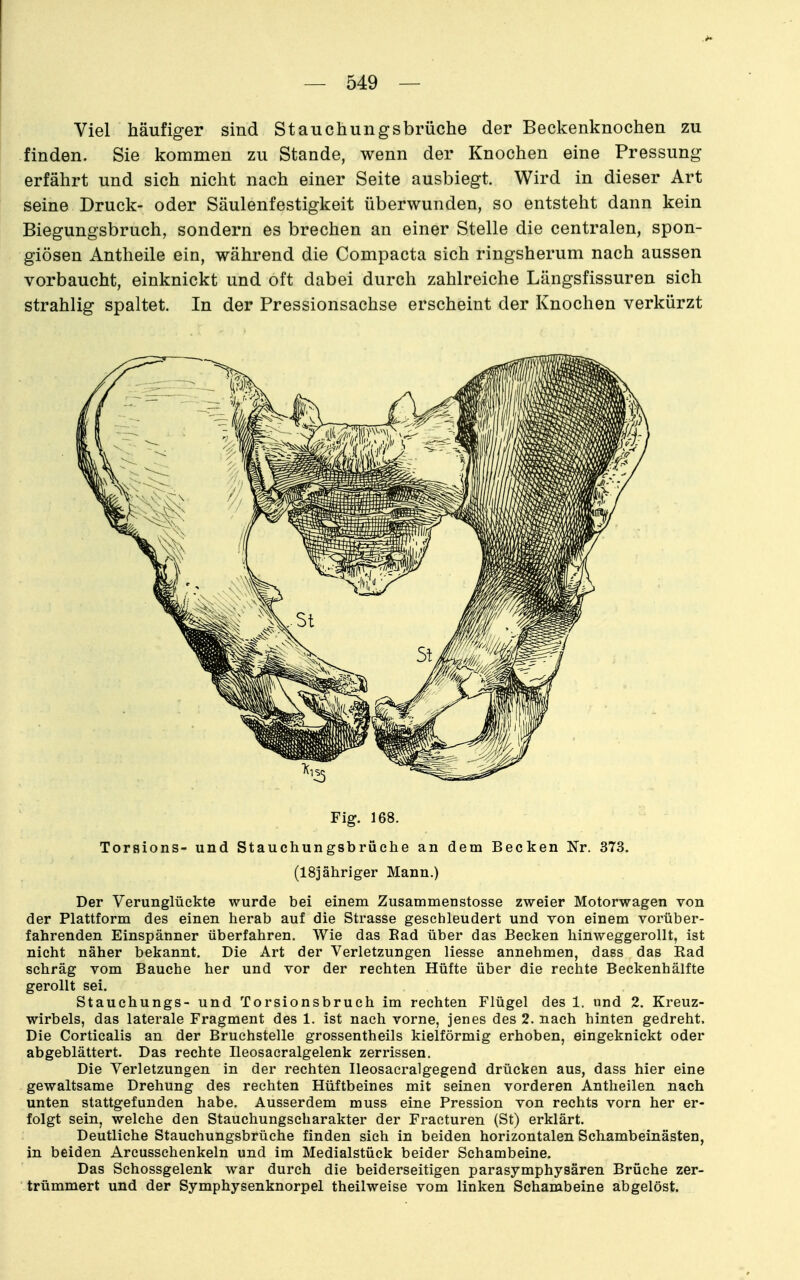 Viel häufiger sind Stauchungsbrüche der Beckenknochen zu finden. Sie kommen zu Stande, wenn der Knochen eine Pressung erfährt und sich nicht nach einer Seite ausbiegt. Wird in dieser Art seine Druck- oder Säulenfestigkeit überwunden, so entsteht dann kein Biegungsbruch, sondern es brechen an einer Stelle die centralen, spon- giösen Antheile ein, während die Compacta sich ringsherum nach aussen vorbaucht, einknickt und oft dabei durch zahlreiche Längsfissuren sich strahlig spaltet. In der Pressionsachse erscheint der Knochen verkürzt Fig. 168. Torsions- und Stauchungsbrüche an dem Becken Nr. 373. (18]ähriger Mann.) Der Verunglückte wurde bei einem Zusammenstosse zweier Motorwagen von der Plattform des einen herab auf die Strasse geschleudert und von einem vorüber- fahrenden Einspänner überfahren. Wie das Ead über das Becken liinweggerollt, ist nicht näher bekannt. Die Art der Verletzungen Hesse annehmen, dass das Rad schräg vom Bauche her und vor der rechten Hüfte über die rechte Beckenhälfte gerollt sei. Stauchungs- und Torsionsbruch im rechten Flügel des 1. und 2. Kreuz- wirbels, das laterale Fragment des 1. ist nach vorne, jenes des 2. nach hinten gedreht. Die Corticalis an der Bruchstelle grossentheils kielförmig erhoben, eingeknickt oder abgeblättert. Das rechte Ileosacralgelenk zerrissen. Die Verletzungen in der rechten Ileosacralgegend drücken aus, dass hier eine gewaltsame Drehung des rechten Hüftbeines mit seinen vorderen Antheilen nach unten stattgefunden habe. Ausserdem muss eine Pression von rechts vorn her er- folgt sein, welche den Stauchungscharakter der Fracturen (St) erklärt. Deutliche Stauchungsbrüche finden sich in beiden horizontalen Schambeinästen, in beiden Arcusschenkeln und im Medialstück beider Schambeine. Das Schossgelenk war durch die beiderseitigen parasymphysären Brüche zer- trümmert und der Symphysenknorpel theilweise vom linken Schambeine abgelöst.
