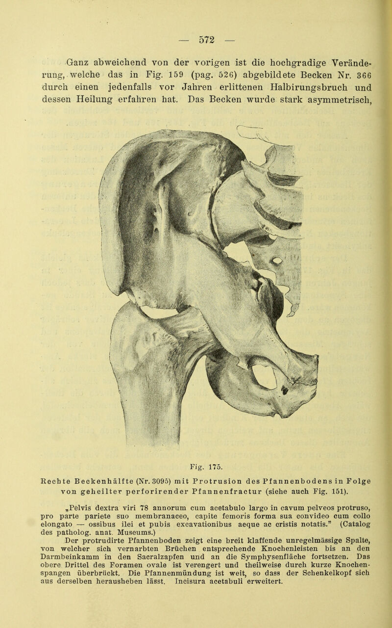 Ganz abweichend von der vorigen ist die hochgradige Verände- rung, welche das in Fig. 159 (pag. 526) abgebildete Becken Nr. 366 durch einen jedenfalls vor Jahren erlittenen Halbirungsbruch und dessen Heilung erfahren hat. Das Becken wurde stark asymmetrisch, Fig. 175. Rechte Beckenhälfte (Nr. 3095) mit Protrusion des Pfannenbodens in Folge von geheilter perforirender Pfannenfractur (siehe auch Fig. 151). „Pelvis dextra viri 78 annorum cum acetabulo largo in cavum pelveos protruso, pro parte pariete suo membranaceo, capite femoris forma sua convideo cum collo elongato — ossibus ilei et pubis excavationibus aeque ac cristis notatis. (Catalog des patholog. anat. Museums.) Der protrudirte Pfannenboden zeigt eine breit klaffende unregelmässige Spalte, von welcher sich vernarbten Brüchen entsprechende Knochenleisten bis an den Darmbeinkamm in den Sacralzapfen und an die Symphysenfläche fortsetzen. Das obere Drittel des Foramen ovale ist verengert und theilweise durch kurze Knochen- spangen überbrückt. Die Pfannenmündung ist weit, so dass der Schenkelkopf sich aus derselben herausheben lässt. Ineisura acetabuli erweitert.