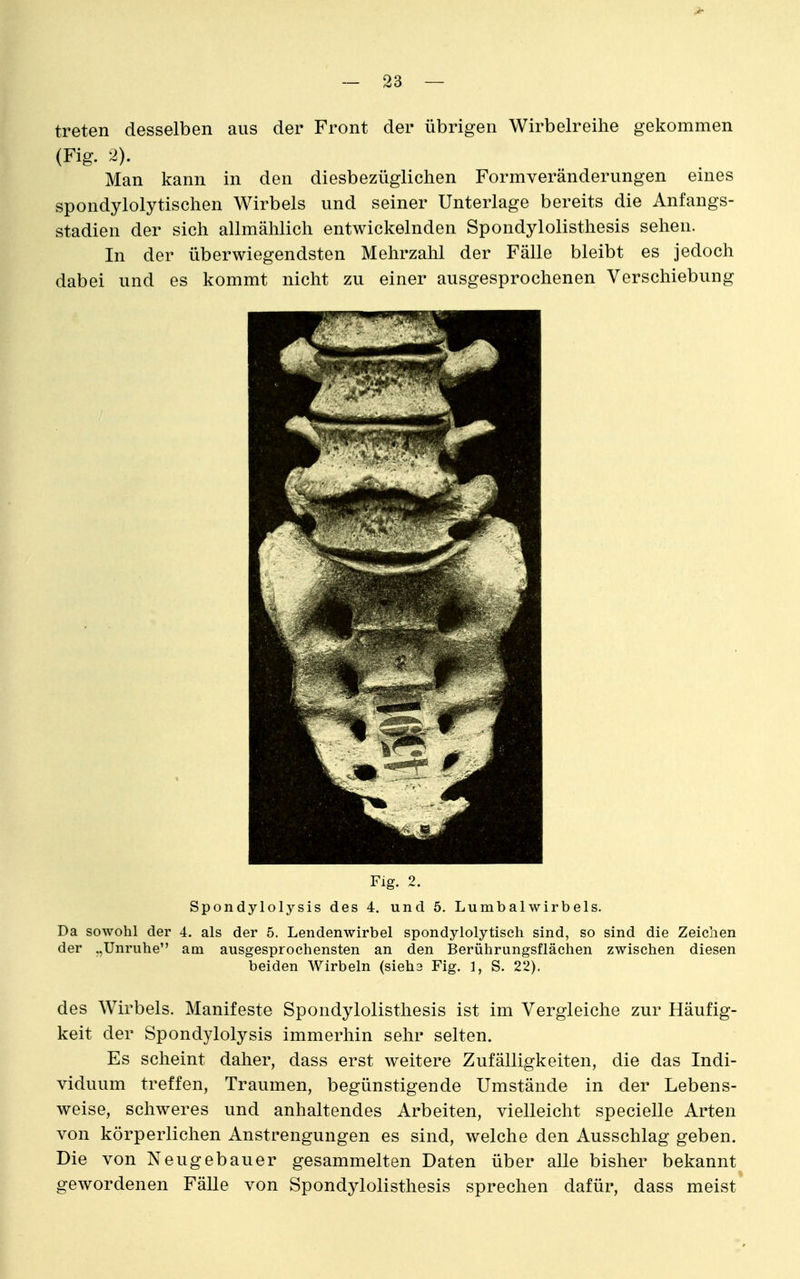 treten desselben aus der Front der übrigen Wirbelreihe gekommen (Fig. 2). Man kann in den diesbezüglichen Formveränderungen eines spondylolytischen Wirbels und seiner Unterlage bereits die Anfangs- stadien der sich allmählich entwickelnden Spondylolisthesis sehen. In der überwiegendsten Mehrzahl der Fälle bleibt es jedoch dabei und es kommt nicht zu einer ausgesprochenen Verschiebung Flg. 2. Spondylolysis des 4. und 5. Lumb al wirb eis. Da sowohl der 4. als der 5. Lendenwirbel spondylolytiseh sind, so sind die Zeichen der „Unruhe am ausgesprochensten an den Berührungsflächen zwischen diesen beiden Wirbeln (sieha Fig. 1, S. 22). des Wirbels. Manifeste Spondylolisthesis ist im Vergleiche zur Häufig- keit der Spondylolysis immerhin sehr selten. Es scheint daher, dass erst weitere Zufälligkeiten, die das Indi- viduum treffen, Traumen, begünstigende Umstände in der Lebens- weise, schweres und anhaltendes Arbeiten, vielleicht specielle Arten von körperlichen Anstrengungen es sind, welche den Ausschlag geben. Die von Neugebauer gesammelten Daten über alle bisher bekannt gewordenen Fälle von Spondylolisthesis sprechen dafür, dass meist