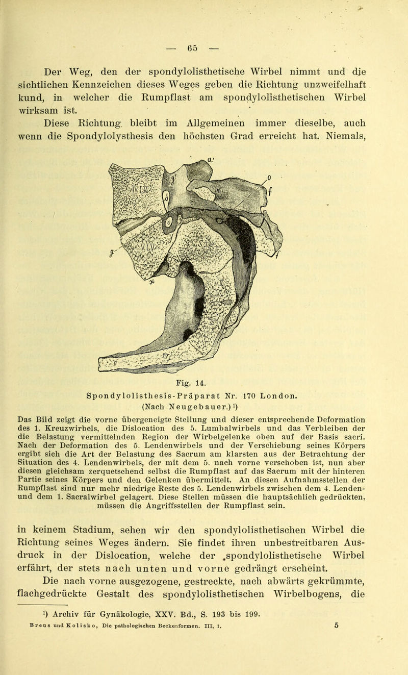 Der Weg, den der spondylolisthetische Wirbel nimmt und die sichtlichen Kennzeichen dieses Weges geben die Richtung unzweifelhaft kund, in welcher die Rumpflast am spondylolisthetischen Wirbel wirksam ist. Diese Richtung, bleibt im Allgemeinen immer dieselbe, auch wenn die Spondylolysthesis den höchsten Grad erreicht hat. Niemals, Fig. 14. Spondylolisthesis-Präparat Nr. 170 London. (Nach Neugebauer,) 1) Das Bild zeigt die vorne übergeneigte Stellung und dieser entsprechende Deformation des 1. Kreuzwirbels, die Dislocation des 5. Lumbalwirbels und das Verbleiben der die Belastung vermittelnden Region der Wirbelgelenke oben auf der Basis sacri. Nach der Deformation des 5. Lendenwirbels und der Verschiebung seines Körpers ergibt sich die Art der Belastung des Sacrum am klarsten aus der Betrachtung der Situation des 4. Lendenwirbels, der mit dem 5. nach vorne verschoben ist, nun aber diesen gleichsam zerquetschend selbst die Rumpflast auf das Sacrum mit der hinteren Partie seines Körpers und den Gelenken übermittelt. An diesen Aufnahmsstellen der Rumpflast sind nur mehr niedrige Reste des 5. Lendenwirbels zwischen dem 4. Lenden- und dem 1. Sacralwirbel gelagert. Diese Stellen müssen die hauptsächlich gedrückten, müssen die Angriffsstellen der Rumpflast sein. in keinem Stadium, sehen wir den spondylolisthetischen Wirbel die Richtung seines Weges ändern. Sie findet ihren unbestreitbaren Aus- druck in der Dislocation, welche der ,spondylolisthetische Wirbel erfährt, der stets nach unten und vorne gedrängt erscheint. Die nach vorne ausgezogene, gestreckte, nach abwärts gekrümmte, flachgedrückte Gestalt des spondylolisthetischen Wirbelbogens, die 1) Archiv für Gynäkologie, XXV. Bd., S. 193 bis 199. Breus undKolisko, Die pathologischen Beckenformen. III, 1. 5