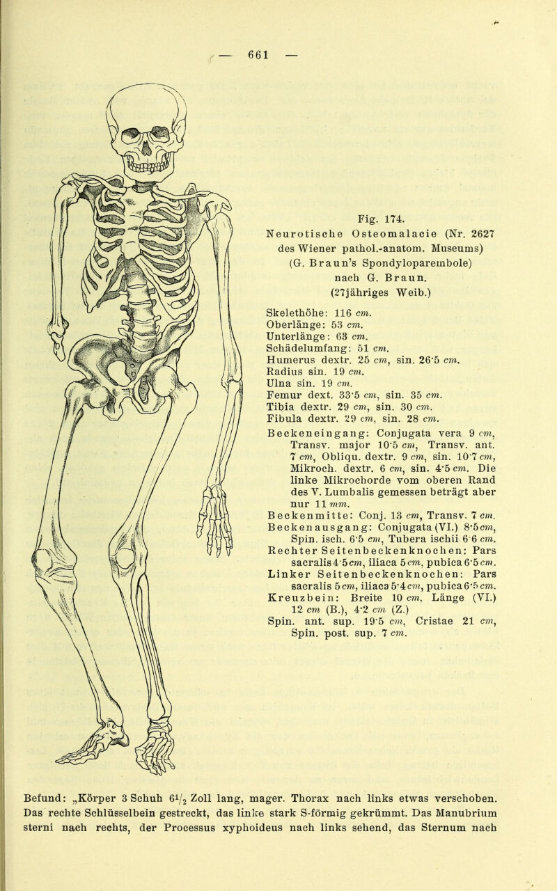 Fig. 174. Neurotische Osteomalacie (Nr. 2627 des Wiener pathol.-anatom. Museums) (G. Braun's Spondyloparembole) nach G. Braun. (27jähriges Weib.) Skelethöhe: 116 cm. Oberlänge: 53 cm. Unterlänge: 63 cm. Sehädelumfang: 51 cm. Humerus dextr. 25 cw, sin. 26'5 cm. Radius sin. 19 cm. Ulna sin, 19 cm. Femur dext. 33*5 cm, sin. 35 cm. Tibia dextr. 29 cm, sin. 30 cm. Fibula dextr. 29 cm, sin. 28 cm. Beckeneingang; Conjugata vera 9 cm, Transv. major 10*5 cm, Transv. ant. 7 cm, Obliqu. dextr. 9 cm, sin. 107 cm, Mikroch. dextr. 6 cm, sin. 4*5 cm. Die linke Mikrochorde vom oberen Rand des V. Lumbalis gemessen beträgt aber nur 11 mm. Beckenmitte: Conj. 13 cm, Transv. 7 cm. Becken ausgang: Conjugata (VI.) 8*5cm, Spin. isch. 6'5 cn?, Tubera ischii 6 6 cm. Rechter Seitenbeckenknochen: Pars sacralis4 5cm, iliaca 5 cm, pubica 6'5 cm. Linker Seitenbeckenknochen: Pars sacralis 5cm, iliaca 5'4c7?i, pubica65 cm. Kreuzbein: Breite 10 cm, Länge (VI.) 12 cm (B.), 4-2 cm (Z.) Spin. ant. sup. 195 C7», Cristae 21 cm, Spin. post. sup. 7 cm. Befund: „Körper 3 Schuh 6V2 Zoll lang, mager. Thorax nach links etwas verschoben. Das rechte Schlüsselbein gestreckt, das linke stark S-förmig gekrümmt. Das Manubrium sterni nach rechts, der Processus xyphoideus nach links sehend, das Sternum nach