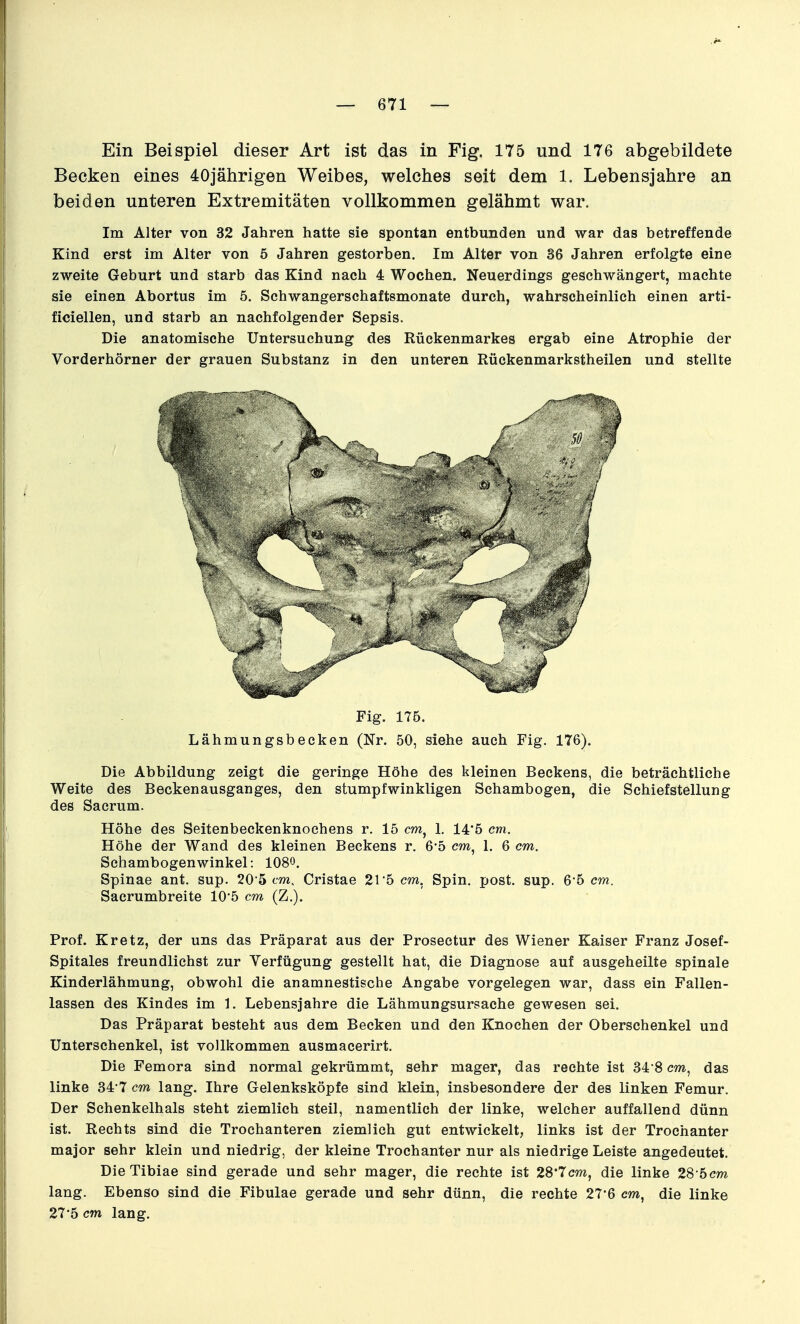 Ein Beispiel dieser Art ist das in Fig. 175 und 176 abgebildete Becken eines 40jährigen Weibes, welches seit dem 1. Lebensjahre an beiden unteren Extremitäten vollkommen gelähmt war. Im Alter von 32 Jahren hatte sie spontan entbunden und war das betreffende Kind erst im Alter von 5 Jahren gestorben. Im Alter von 36 Jahren erfolgte eine zweite Geburt und starb das Kind nach 4 Wochen. Neuerdings geschwängert, machte sie einen Abortus im 5. Schwangerschaftsmonate durch, wahrscheinlich einen arti- ficiellen, und starb an nachfolgender Sepsis. Die anatomische Untersuchung des Rückenmarkes ergab eine Atrophie der Vorderhörner der grauen Substanz in den unteren Rückenmarkstheilen und stellte Fig. 176. Lähmungsbecken (Nr. 50, siehe auch Fig. 176). Die Abbildung zeigt die geringe Höhe des kleinen Beckens, die beträchtliche Weite des Beckenausganges, den stumpfwinkligen Schambogen, die Schiefstellung des Sacrum. Höhe des Seitenbeckenknoehens r. 15 cm, 1. 14'5 cm. Höhe der Wand des kleinen Beckens r. 6*5 cm, 1. 6 cm. Sehambogenwinkel: 1080. Spinae ant. sup. 205 cm, Cristae 21 5 cm, Spin, post. sup. 6'5 cm. Sacrumbreite 105 cm (Z.). Prof. Kretz, der uns das Präparat aus der Prosectur des Wiener Kaiser Franz Josef- Spitales freundlichst zur Verfügung gestellt hat, die Diagnose auf ausgeheilte spinale Kinderlähmung, obwohl die anamnestische Angabe vorgelegen war, dass ein Fallen- lassen des Kindes im 1. Lebensjahre die Lähmungsursache gewesen sei. Das Präparat besteht aus dem Becken und den Knochen der Oberschenkel und Unterschenkel, ist vollkommen ausmacerirt. Die Femora sind normal gekrümmt, sehr mager, das rechte ist 34 8 cm, das linke 34'7 cm lang. Ihre Gelenksköpfe sind klein, insbesondere der des linken Femur. Der Schenkelhals steht ziemlich steil, namentlich der linke, welcher auffallend dünn ist. Rechts sind die Trochanteren ziemlich gut entwickelt, links ist der Trochanter major sehr klein und niedrig, der kleine Trochanter nur als niedrige Leiste angedeutet. DieTibiae sind gerade und sehr mager, die rechte ist 28'7cm, die linke 28-5cm lang. Ebenso sind die Fibulae gerade und sehr dünn, die rechte 27'6 cm, die linke 27*5 cm lang.