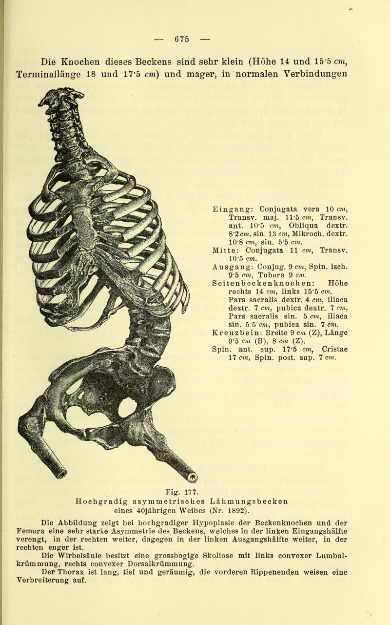 Die Küochen dieses Beckens sind sehr klein (Höhe 14 und 15-5 cm, Terminallänge 18 und 17*5 cm) und mager, in normalen Verbindungen Eingang: Conjugata vera 10 cm^ Transv. maj. 11-5 cw, Transv. ant. 10*5 cm, Obliqua dextr. 82cm, sin. 13 cm, Mikroch. dextr. 10*8 cm, sin. 5*5 cm. Mitte: Conjugata 11 cm, Transv. 105 cm. Ausgang: Conjug. 9 cm, Spin. isch. 95 cm, Tubera 9 cm. Seitenb eckenknoch en: Höhe rechts 14 cm, links 15'5 cm. Pars saeralis dextr. 4 cm, iliaca dextr. 7 cvi, pubica dextr. 7 cm, Pars saeralis sin. 5 cm, iliaca sin. 5-5 cm, pubica sin. 7 cm. Kreuzbein: Breite 9 cm (Z), Länge 9-5 cm (B), 8 cm (Z). Spin. ant. sup. 17'5 cm, Cristae 17 cm, Spin, post. sup. 7 cm. Fig. 177. Hochgradig asymmetrisches Lähmungsbecken eines 40jährigen Weibes (Nr. 1892). Die Abbildung zeigt bei hochgradiger Hypoplasie der Beckenknochen und der Femora eine sehr starke Asymmetrie des Beckens, welches in der linken Eingangshälfte verengt, in der rechten weiter, dagegen in der linken Ausgangshälfte weiter, in der rechten enger ist. Die Wirbelsäule besitzt eine grossbogige Skoliose mit links convexer Lumbai- krümmung, rechts convexer Dorsalkrümmung. Der Thorax ist lang, tief und geräumig, die vorderen Rippenenden weisen eine Verbreiterung auf.