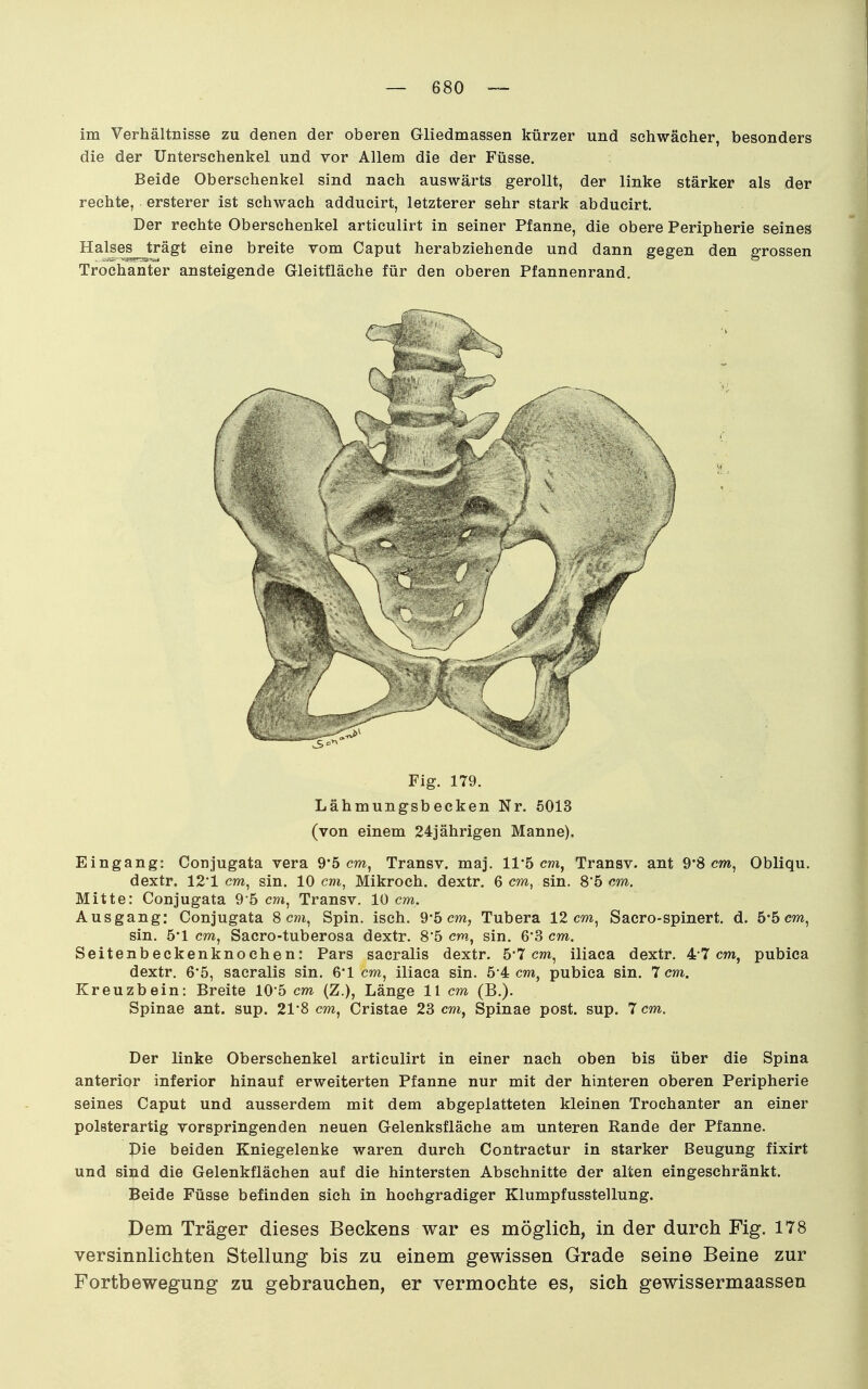 im Verhältnisse zu denen der oberen Gliedmassen kürzer und schwächer, besonders die der Unterschenkel und vor Allem die der Füsse. Beide Oberschenkel sind nach auswärts gerollt, der linke stärker als der rechte, ersterer ist schwach adducirt, letzterer sehr stark abducirt. Der rechte Oberschenkel articulirt in seiner Pfanne, die obere Peripherie seines Halses trägt eine breite vom Caput herabziehende und dann gegen den grossen Trochanter ansteigende Gleitfläche für den oberen Pfannenrand. Fig, 179. Lähmungsbecken Nr. 5013 (von einem 24jährigen Manne). Eingang: Conjugata vera 9*5 cm, Transv. maj. 11*5 cm, Transv. ant 9'8 cm, Obliqu. dextr. 121 cm, sin. 10 cm, Mikroch. dextr. 6 cw, sin. 8'5 cm, Mitte: Conjugata 9 5 cm, Transv. 10 cm. Ausgang: Conjugata 8 cm, Spin. isch. 9-5 cm, Tubera 12 cm, Sacro-spinert. d. 5*5 cm, sin. 5*1 cm, Sacro-tuberosa dextr. 85 cm, sin. 6*3 cm. Seitenbeckenknochen: Pars sacralis dextr. 5*7 cm, iliaca dextr. 47 cm, pubica dextr. 6'5, sacralis sin. 6*1 cm, iliaca sin. 5 4 cm, pubica sin. 7 cm. Kreuzbein: Breite 10*5 cm (Z.), Länge 11 cm (B.). Spinae ant. sup. 21*8 cm, Cristae 23 cm, Spinae post. sup. 7 cm. Der linke Oberschenkel articulirt in einer nach oben bis über die Spina anterior inferior hinauf erweiterten Pfanne nur mit der hinteren oberen Peripherie seines Caput und ausserdem mit dem abgeplatteten kleinen Trochanter an einer polsterartig vorspringenden neuen Gelenksfläche am unteren Rande der Pfanne. Pie beiden Kniegelenke waren durch Contractur in starker Beugung fixirt und sind die Gelenkflächen auf die hintersten Abschnitte der alten eingeschränkt. Beide Füsse befinden sich in hochgradiger Klumpfusstellung. Dem Träger dieses Beckens war es möglich, in der durch Fig. 178 versinnlichten Stellung bis zu einem gewissen Grade seine Beine zur Fortbewegung zu gebrauchen, er vermochte es, sich gewissermaassen