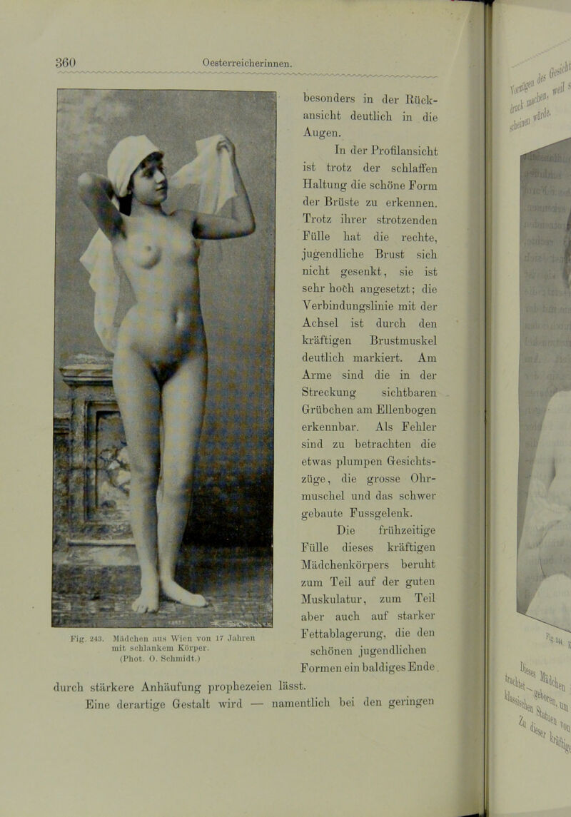 Fig. 243. Mädchen aus Wien von 17 Jahren mit schlankem Körper. (Phot. 0. Schmidt.) besonders in der Rück- ansicht deutlich in die Augen. In der Profilansicht ist trotz der schlaffen Haltung die schöne Form der Brüste zu erkennen. Trotz ihrer strotzenden Fülle hat die rechte, jugendliche Brust sich nicht gesenkt, sie ist sehr hoch angesetzt; die Verbindungslinie mit der Achsel ist durch den kräftigen Brustmuskel deutlich markiert. Am Arme sind die in der Streckung sichtbaren Grübchen am Ellenbogen erkennbar. Als Fehler sind zu betrachten die etwas plumpen Gesichts- züge , die grosse Ohr- muschel und das schwer gebaute Fussgelenk. Die frühzeitige Fülle dieses kräftigen Mädchenkörpers beruht zum Teil auf der guten Muskulatur, zum Teil aber auch auf starker Fettablagerung, die den schönen jugendlichen Formen ein baldiges Ende durch stärkere Anhäufung prophezeien lässt. Eine derartige Gestalt wird — namentlich bei den geringen