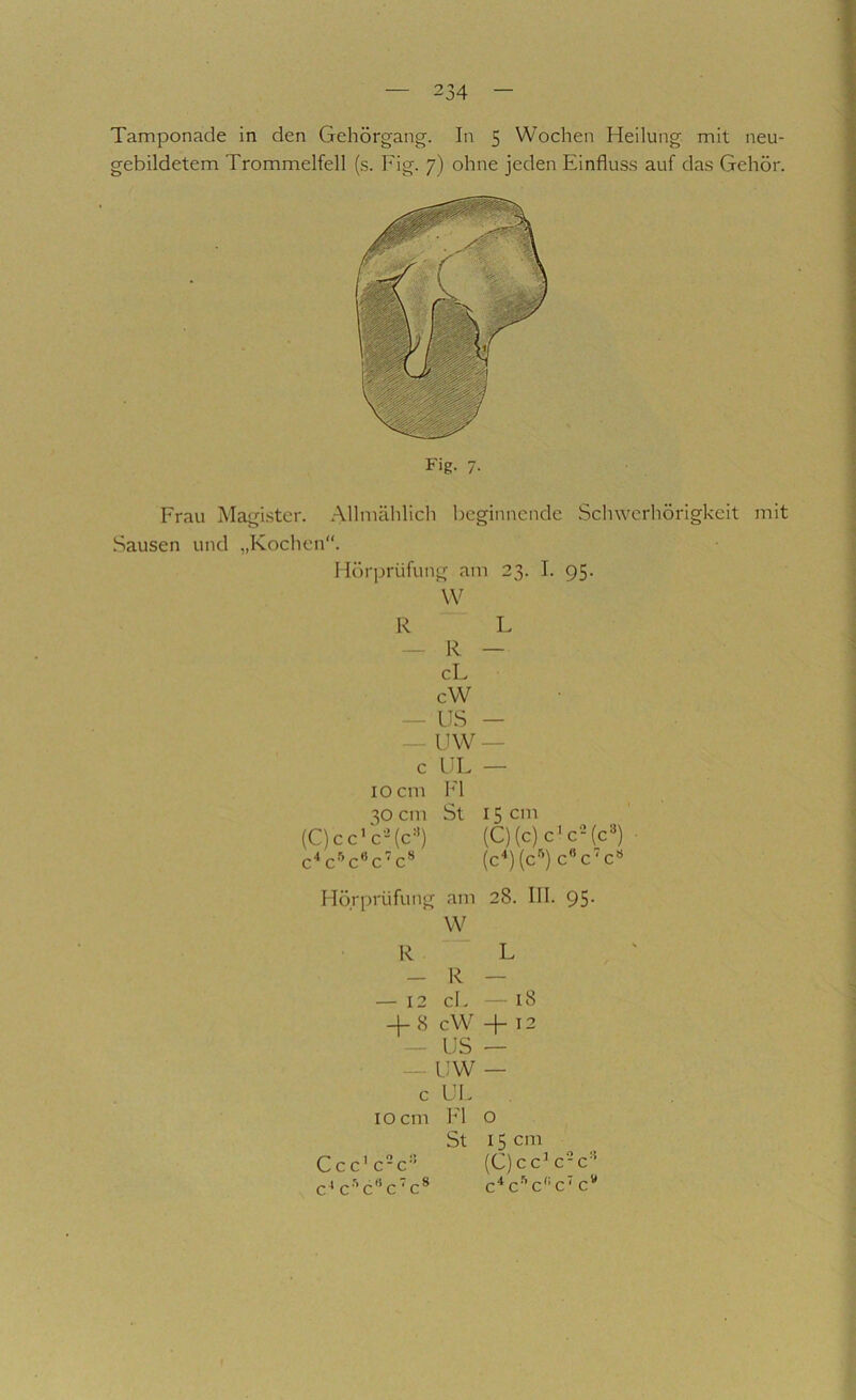 Tamponade in den Gehörgang. In 5 Wochen Heilung mit neu- gebildetem Trommelfell (s. Fig. 7) ohne jeden Einflus.s auf das Gehör. Fig. /• Frau Magister. Allmählich beginnende Schwerhörigkeit mit Sausen und „Kochen“. Hörjjrüfung am 23. I. 95. W R L — R — cL cW — US — — UW — c UL — IO cm h'l 30 cm St 15 cm (C)cc'c'^(c=^) (C)(c)c’c‘Mc«) • c'‘c'^c‘’c‘c** (c^)(c'^) cc'c« Hörprüfung am 28. III. 95- W R L - R — — 12 cL — 18 -1- 8 c W + 12 - US — — UW — c UL IO cm Fl o St 15 cm Ccc'c-c (C)cc^c-c'^ c^ c’'c'’c'c* c^c-'’c''c‘c'*