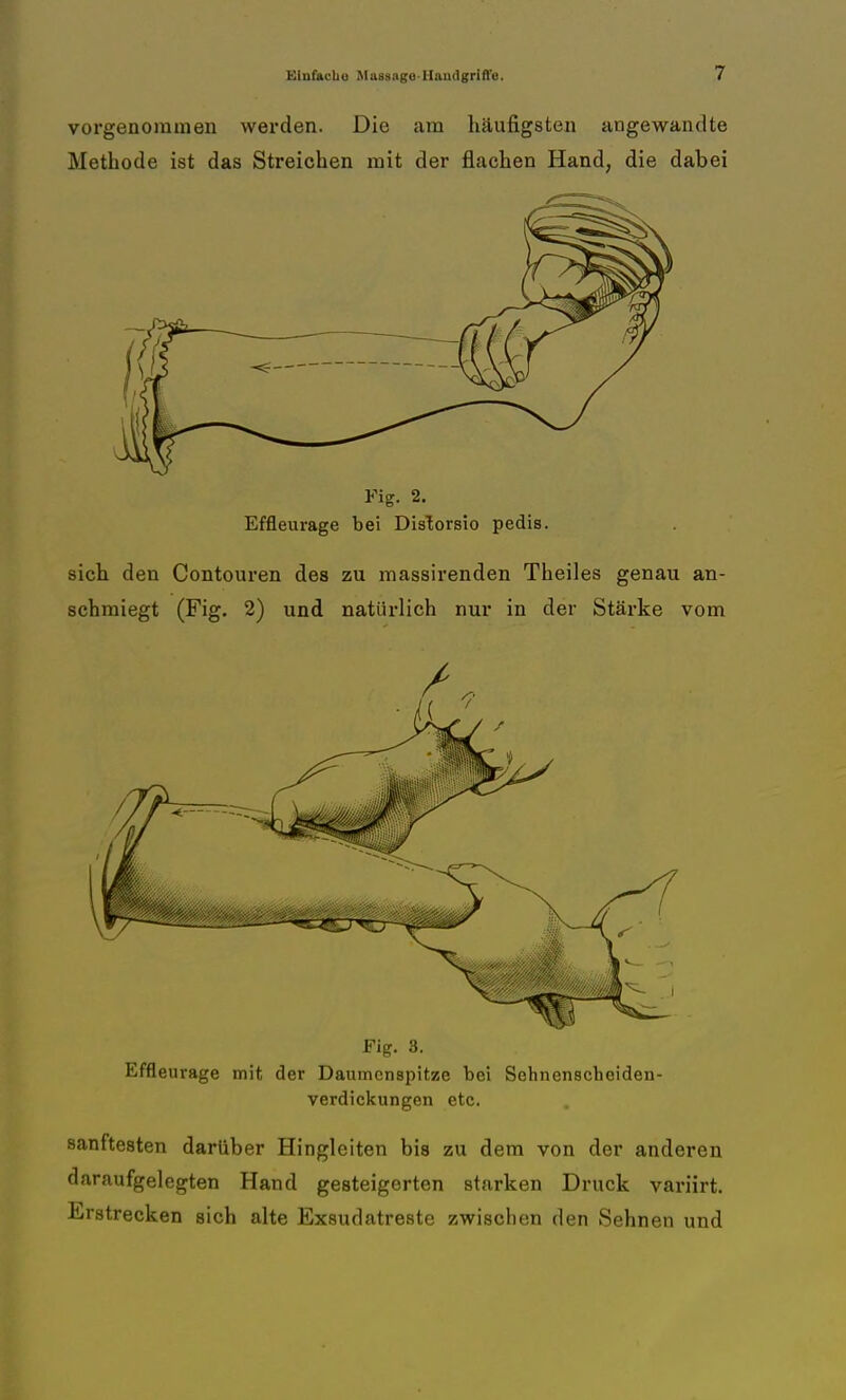 vorgenommen werden. Die am häufigsten angewandte Methode ist das Streichen mit der flachen Hand, die dabei Fig. 2. Effleurage bei Distorsio pedis. sich den Contouren des zu massirenden Theiles genau an- schmiegt (Fig. 2) und natürlich nur in der Stärke vom Fig. 3. Effleurage mit der Daumenspitze bei Sehnenscheiden Verdickungen etc. sanftesten darüber Hingleiten bis zu dem von der anderen daraufgelegten Hand gesteigerten starken Druck variirt. Erstrecken sich alte Exsudatreste zwischen den Sehnen und