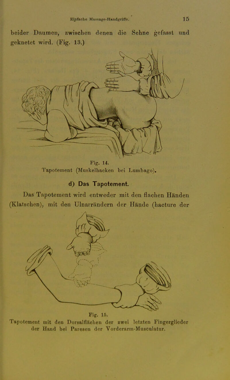 beider Daumen, zwischen denen die Sehne gefasst und geknetet wird. (Fig. 13.) Fig. 14. Tapotement (Muskelhacken bei Lumbago), d) Das Tapotement. Das Tapotement wird entweder mit den flachen Händen (Klatschen), mit den Ulnarrändern der Hände (hacture der Fig. 16. Tapotement mit den Dorsal flächen der zwei letzten Fingerglicder der Hand bei Paresen der Vorderarm-Musculatur.