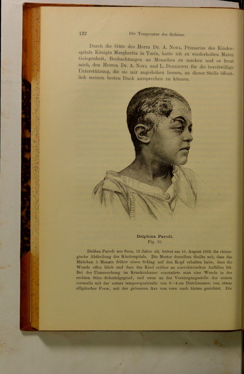 Duicli die Güte des Herrn Dr. A. Nota, Primarius des Kinder- spitals Königin Margherita in Turin, hatte icli zu wiederliolten Malen Gelegenheit, Beohachtungen an Menschen zu machen und es freut mich, den Herren Dr. A. Nota und L. Dooliotti für die bereitwillige Unterstützung, die sie mir angedeihen Hessen, an dieser Stelle öffent- lich meinen besten Dank aussprechen zu können. Delphina Parodi. Fig. 35. Delfina Parodi aus Susa, 12 Jahre alt, betrat am 16. August 1892 die chirur- gische Abtheilung des Kinderspitals. Die Mutter derselben theilte mit, dass das Mädchen 5 Monate früher einen Schlag auf den Kopf erhalten habe, dass die Wunde offen blieb und dass das Kind seither an convnlsivischen Anfällen litt. Bei der Untersuchung im Krankenhause constatirte man eine Wunde in der rechten Stirn-Scheitelgegend, und zwar an der Vereinigmigsstelle der sutura coronalis mit der sutura temporoparietalis von 3—4 cm Durchmesser, von etwas elliptischer Form, mit der grösseren Axe von vorn nach hinten gerichtet. Die