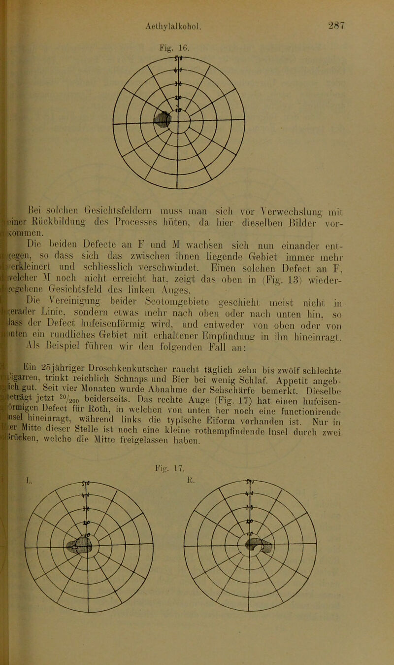 Fig. IG. Bei solchen Gesichtsfeldern muss man sich vor Verwechslung mit einer Rückbildung des Proces.ses hüten, da hier dieselben Bilder Vor- kommen. Die beiden Defecte an F und M wachsen sich nun einander ent- gegen. so dass sich das zwischen ihnen liegende Gebiet immer mehr verkleinert und schliesslich verschwindet. Einen solchen Dcfect an F. velcher M noch nicht erreicht hat. zeigt das oben in (Fig. 13) wieder- regebene Gesichtsfeld des linken Auges. Die Vereinigung beider Scotomgebiete geschieht meist nicht, in gerader Linie, sondern etwas mehr nach oben oder nach unten hin. so lass der Defect hufeisenförmig wird, und entweder von oben oder von mien ein rundliches Gebiet mit erhaltener Empfindung in ihn hineinragt. IAls Beispiel führen wir den folgenden Fall an: L Ein 25jähriger Droschkenkutscher raucht täglich zehn bis zwölf schlechte Ligarren, trinkt reichlich Schnaps und Bier bei wenig Schlaf. Appetit angeb- lich gut.. Seit vier Monaten wurde Abnahme der Sehschärfe bemerkt. Dieselbe beträgt jetzt 2<y200 beiderseits. Das rechte Auge (Fig. 17) hat einen hufeisen- förmigen Defect für Roth, in welchen von unten her noch eine functionirende Insel luiieinragt. während links die typische Eiform vorhanden ist. Nur in Ger Mitte dieser Stelle ist noch eine kleine rothempfindende Insel durch zwei »»»rucken, welche die Mitte freigelassen haben.