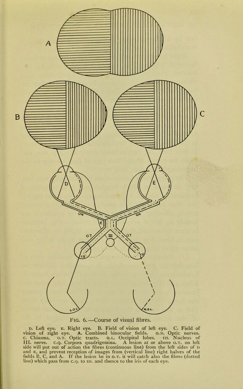 d. Left eye. e. Right eye. B. Field of vision of left eye. C. Field of vision of right eye. A. Combined binocular fields. o. n. Optic nerves, c. Chiasma. o.t. Optic tracts. o.l. Occipital lobes. hi. Nucleus of III. nerve. C.Q. Corpora quadrigemina. A lesion at or above o.t. on left side will put out of action the fibres (continuous line) from the left sides of d and e, and prevent reception of images from (vertical line) right halves of the fields B, C, and A. If the lesion be in o.t. it will catch also the fibres (dotted line) which pass from c.Q. to m. and thence to the iris of each eye.